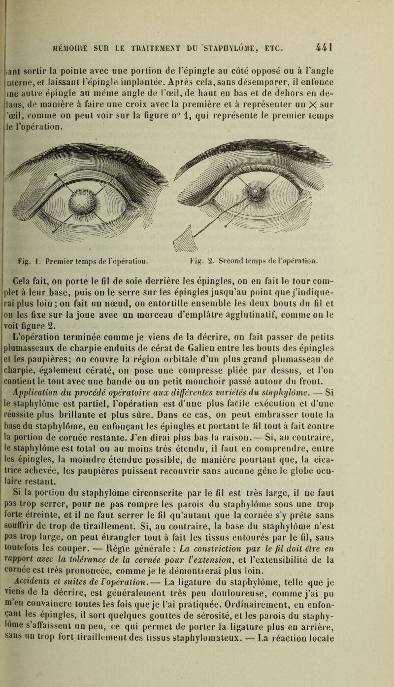 ;ant sortir la pointe avec une portion de l’épingle au côté opposé ou à l’angle interne,et laissant l’épingle implantée. Après cela,sans désemparer, il enfonce me autre épingle au même angle de l’œil, de haut en bas et de dehors en de- ians, de manière à faire une croix avec la première et à représenter un X sur ’œil, comme on peut voir sur la figure n° 1, qui représente le premier temps le l’opération. Fig. i. Premier temps de l’opération. Fig. 2. Second temps de l’opération. Cela fait, on porte le fil de soie derrière les épingles, on en fait le tour com- plet à leur base, puis on le serre sur les épingles jusqu’au point que j’indique- rai plus loin ; on fait un nœud, on entortille ensemble les deux bouts du fil et on les fixe sur la joue avec un morceau d’emplâtre agglutinatif, comme on le voit figure 2. L’opération terminée comme je viens de la décrire, on fait passer de petits plumasseaux de charpie enduits de cérat de Galien entre les bouts des épingles et les paupières; on couvre la région orbitale d’un plus grand plumasseau de charpie, également cératé, on pose une compresse pliée par dessus, et l’on I contient le tout avec une bande ou un petit mouchoir passé autour du front. Application du procédé opératoire aux différentes variétés du staphylôme. — Si le staphylôme est partiel, l’opération est d’une plus facile exécution et d’une réussite plus brillante et plus sûre. Dans ce cas, on peut embrasser toute la base du staphylôme, en enfonçant les épingles et portant le fil tout à fait contre la portion de cornée restante. J’en dirai plus bas la raison. — Si, au contraire, le staphylôme est total ou au moins très étendu, il faut en comprendre, entre les épingles, la moindre étendue possible, de manière pourtant que, la cica- trice achevée, les paupières puissent recouvrir sans aucune gêne le globe ocu- laire restant. Si la portion du staphylôme circonscrite par le fil est très large, il ne faut pas trop serrer, pour ne pas rompre les parois du staphylôme sous une trop forte étreinte, et il ne faut serrer le fil qu’autanl que la cornée s’y prête sans souffrir de trop de tiraillement. Si, au contraire, la base du staphylôme n’est pas trop large, on peut étrangler tout à fait les tissus entourés par le fil, sans toutefois les couper. — Règïe générale : La constriction par le fil doit être en rapport avec la tolérance de la cornée pour l'extension, et l’extensibilité de la cornée est très prononcée, comme je le démontrerai plus loin. Accidents et suites de l'opération.— La ligature du staphylôme, telle que je viens de la décrire, est généralement très peu douloureuse, comme j’ai pu m’en convaincre toutes les fois que je l’ai pratiquée. Ordinairement, en enfon- çant les épingles, il sort quelques gouttes de sérosité, et les parois du staphy- lôme s’affaissent un peu, ce qui permet de porter la ligature plus en arrière, sans un trop fort tiraillement des tissus staphylomateux. — La réaction locale