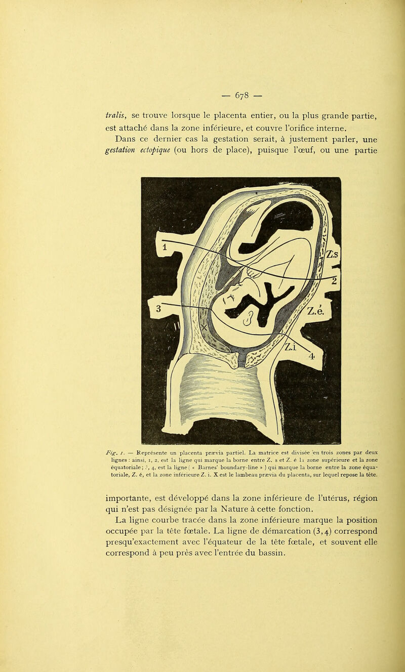 tralis, se trouve lorsque le placenta entier, ou la plus grande partie, est attaché dans la zone inférieure, et couvre l'orifice interne. Dans ce dernier cas la gestation serait, à justement parler, une gestation edopique (ou hors de place), puisque l'œuf, ou une partie Pi^, I• ~ Keprésente un placenta pr^via partiel. La matrice est divisée ^en trois zones par deux lignes : ainsi, i, 2, est la ligne qui marque la borne entre Z. s et Z. é 11 zone supérieure et la zone équatoriale; ,-, 4, est la ligne ( « Barnes' boundary-line » ) qui marque la borne entre la zone équa- toriale, Z. é, et la zone inférieure Z. i. X est le lambeau praevia du placenta, sur lequel repose la tête. importante, est développé dans la zone inférieure de l'utérus, région qui n'est pas désignée par la Nature à cette fonction. La ligne courbe tracée dans la zone inférieure marque la position occupée par la tête fœtale. La ligne de démarcation (3,4) correspond presqu'exactement avec l'équateur de la tête fœtale, et souvent elle correspond à peu près avec l'entrée du bassin.