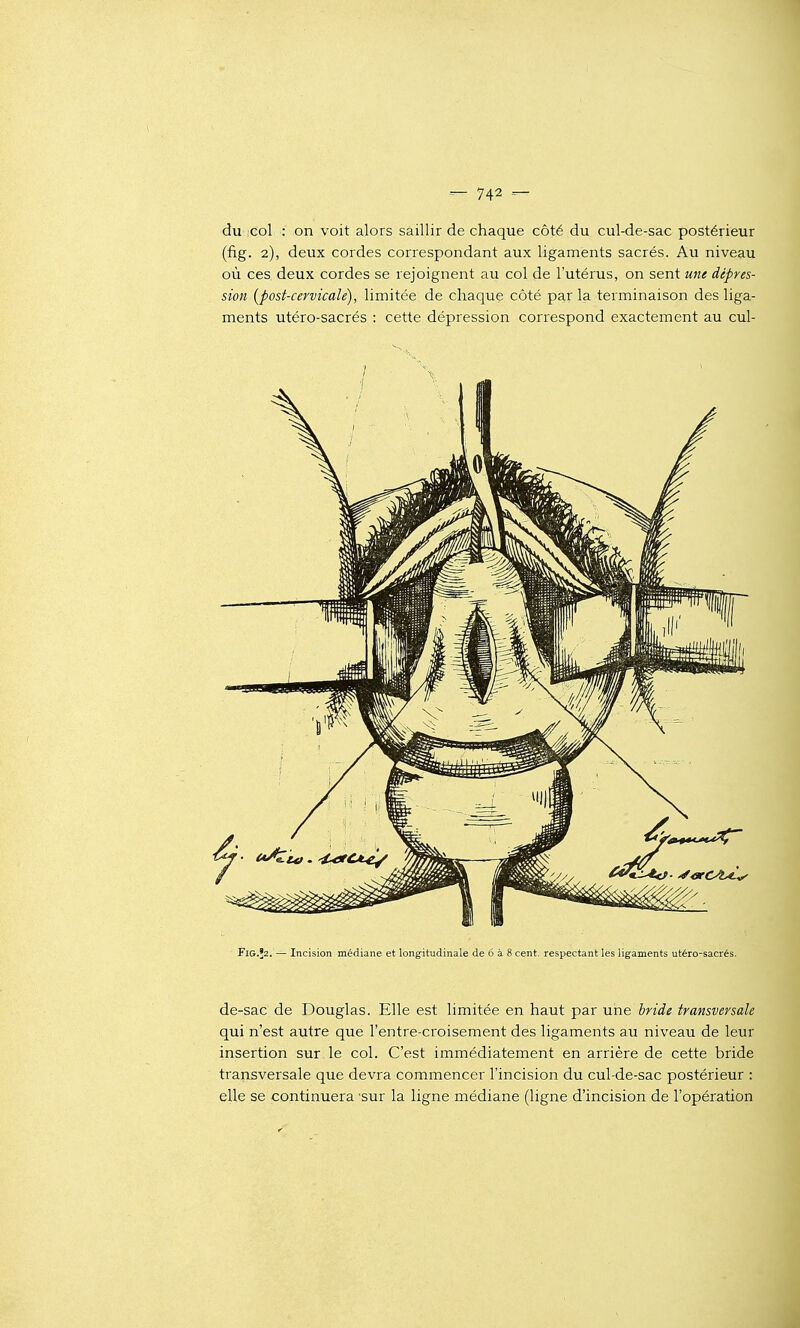 du icol : on voit alors saillir de chaque côté du cul-de-sac postérieur (fig. 2), deux cordes correspondant aux ligaments sacrés. Au niveau où ces deux cordes se rejoignent au col de l'utérus, on sent une dépres- sion [post-cervicale), limitée de chaque côté par la terminaison des liga- ments utéro-sacrés : cette dépression correspond exactement au cul- F1G.52. — Incision médiane et longitudinale de 6 à 8 cent, respectant les ligaments utéro-sacrés. de-sac de Douglas. Elle est limitée en haut par une hride transversale qui n'est autre que l'entre-croisement des ligaments au niveau de leur insertion sur le col. C'est immédiatement en arrière de cette bride transversale que devra commencer l'incision du cul-de-sac postérieur : elle se continuera 'sur la ligne médiane (ligne d'incision de l'opération