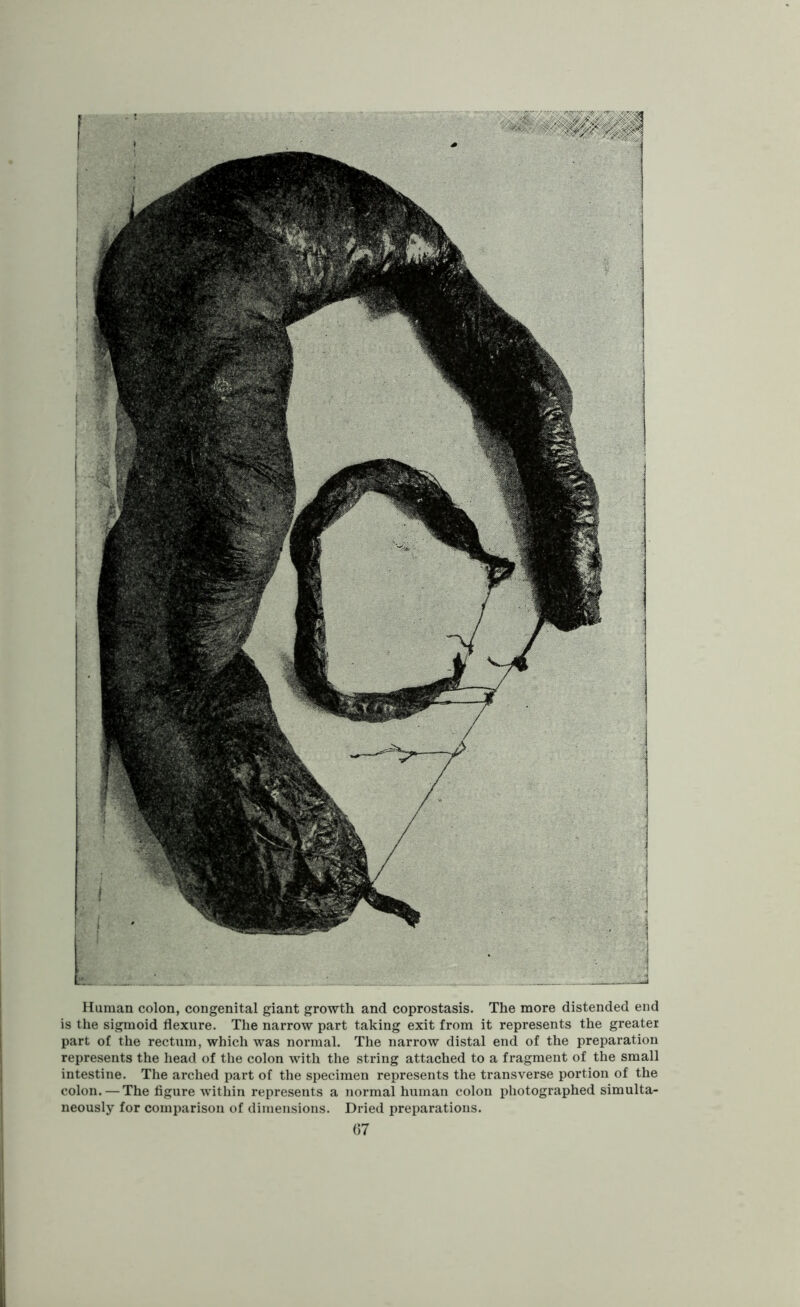 Human colon, congenital giant growth and coprostasis. The more distended end is the sigmoid flexure. The narrow part taking exit from it represents the greater part of the rectum, which was normal. The narrow distal end of the preparation represents the head of the colon with the string attached to a fragment of the small intestine. The arched part of the specimen represents the transverse portion of the colon. — The figure within represents a normal human colon photographed simulta- neously for comparison of dimensions. Dried preparations.