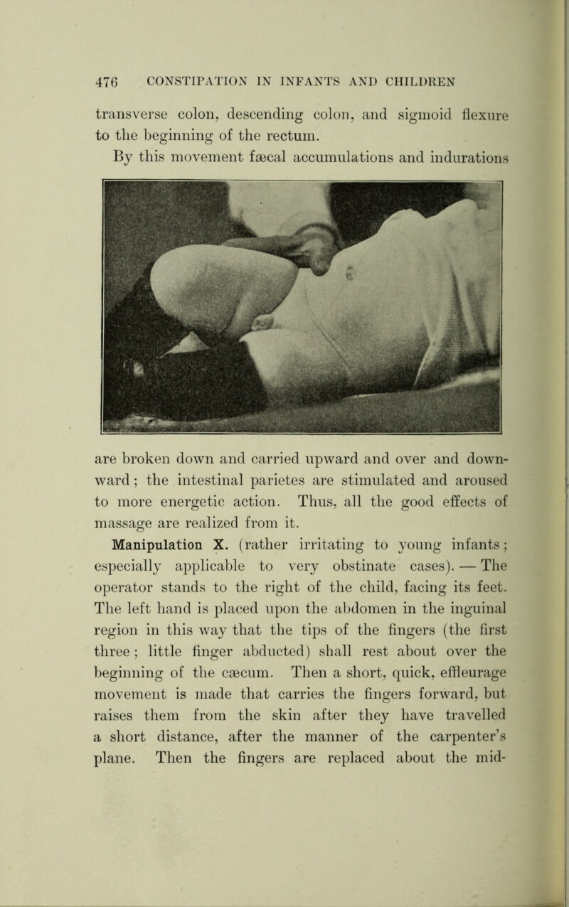 transverse colon, descending colon, and sigmoid flexure to the beginning of the rectum. By this movement faecal accumulations and indurations are broken down and carried upward and over and down- ward ; the intestinal parietes are stimulated and aroused to more energetic action. Thus, all the good effects of massage are realized from it. Manipulation X. (rather irritating to young infants; especially applicable to very obstinate cases). — The operator stands to the right of the child, facing its feet. The left hand is placed upon the abdomen in the inguinal region in this way that the tips of the fingers (the first three ; little finger abducted) shall rest about over the beginning of the caecum. Then a short, quick, effieurage movement is made that carries the fingers forward, but raises them from the skin after they have travelled a short distance, after the manner of the carpenter’s plane. Then the fingers are replaced about the mid-