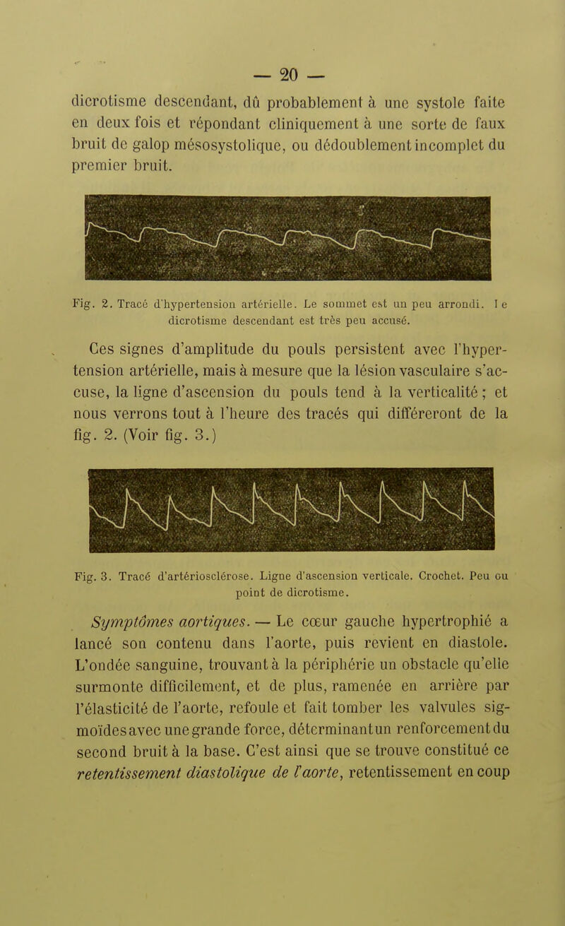 dicrotisme descendant, dû probablement à une systole faite en deux fois et répondant cliniquement à une sorte de faux bruit de galop mésosystolique, ou dédoublement incomplet du premier bruit. Fig. 2. Tracé d'hypertension artérielle. Le sommet est un peu arrondi. le dicrotisme descendant est très peu accusé. Ces signes d'amplitude du pouls persistent avec l'hyper- tension artérielle, mais à mesure que la lésion vasculaire s'ac- cuse, la ligne d'ascension du pouls tend à la verticalité ; et nous verrons tout à l'heure des tracés qui différeront de la fig. 2. (Voir fig. 3.) Fig. 3. Tracé d'artériosclérose. Ligne d'ascension verticale. Crochet. Peu ou point de dicrotisme. Symptômes aortiques. — Le cœur gauche hypertrophié a lancé son contenu dans l'aorte, puis revient en diastole. L'ondée sanguine, trouvant à la périphérie un obstacle qu'elle surmonte difficilement, et de plus, ramenée en arrière par l'élasticité de l'aorte, refoule et fait tomber les valvules sig- moïdes avec une grande force, déterminantun renforcement du second bruit à la base. C'est ainsi que se trouve constitué ce retentissement diastolique de taorte, retentissement en coup