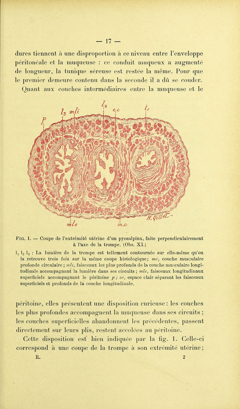 dures tiennent à une disproportion à ce niveau entre l'enveloppe péritonéale et la muqueuse : ce conduit nmqueux a augmenté de longueur, la tunique séreuse est restée la même. Pour que le premier demeure contenu dans la seconde il a dù se couder. Q;uant aux couches intermédiaires entre la muqueuse et le FiG. 1. — Coupe de l'extrémité utérine d'un pyosalpinx, faite perpendiculairement à l'axe de la trompe. (Obs. XI.) 1, I2 I3 : La lumière de la trompe est tellement contournée sur elle-même qu'on la retrouve trois fois sur la même coupe histologique ; 7nc, couche musûulaire profonde circulaire ; iiili, faisceaux les plus profonds de la couche musculaire longi- tudinale accompagnant la lumière dans ses circuits ; mie, faisceaux longitudinaux superficiels accompagnant le péritoine 2^ > i!<^> espace clair séparant les faisceaux superficiels et profonds de la couche longitudinale. péritoine, elles présentent une disposition curieuse : les couches les plus profondes accompagnent la muqueuse dans ses circuits ; les couches superficielles abandonnent les précédentes, passent directement sur leurs plis, restent accolées au péritoine. Cette disposition est bien indiquée par la fig. 1. Celle-ci correspond à une coupe de la trompe à son extrémité utérine ; E. 2