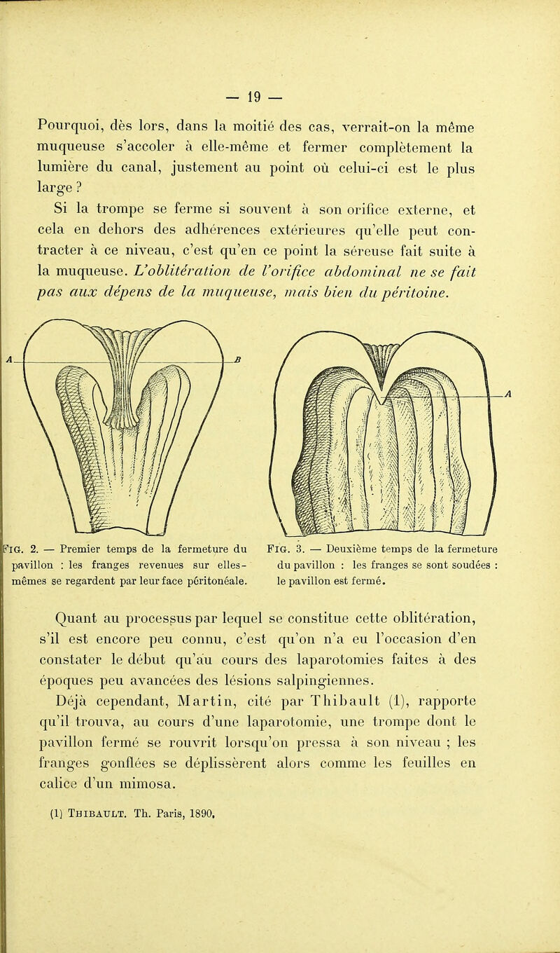 Pourquoi, dès lors, dans la moitié des cas, verrait-on la même muqueuse s'accoler à elle-même et fermer complètement la lumière du canal, justement au point où celui-ci est le plus large ? Si la trompe se ferme si souvent à son orifice externe, et cela en dehors des adhérences extérieures qu'elle peut con- tracter à ce niveau, c'est qu'en ce point la séreuse fait suite à la muqueuse. L'oblitération de l'orifice abdominal ne se fait pas aux dépens de la muqueuse, mais bien du péritoine. FlG. 2. — Premier temps de la fermeture du FiG. 3. — Deuxième temps de la fermeture pavillon : les franges revenues sur elles- du pavillon : les franges se sont soudées : mêmes se regardent par leur face pûritonéale. le pavillon est fermé. Quant au processus par lequel se constitue cette oblitération, s'il est encore peu connu, c'est qu'on n'a eu l'occasion d'en constater le début qu'au cours des laparotomies faites à des époques peu avancées des lésions salpingiennes. Déjà cependant, Martin, cité par Thibault (1), rapporte qu'il trouva, au cours d'une laparotomie, une trompe dont le pavillon fermé se rouvrit lorsqu'on pressa à son niveau ; les franges gonflées se déplissèrent alors comme les feuilles en calice d'un mimosa. (1) Thibault. Th. Paris, 1890.