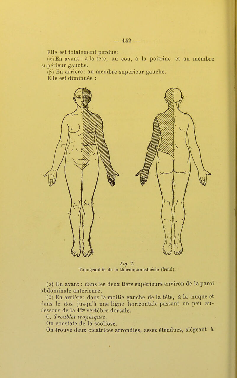 Elle est totalement perdue : (a) En avant : à la tête, au cou, à la poitrine et au membre supérieur gauche. (P) En arrière : au membre supérieur gauche. Elle est diminuée : Fig. 7. Topographie de la thermo-anesthésie (froid). (a) En avant : dans les deux tiers supérieurs environ de la paroi abdominale antérieure. (P) En arrière: dans la moitié gauche de la tête, à la nuque et dans le dos jusqu'à une ligne horizontale passant un peu au- dessous de la 12 vertèbre dorsale. C. Troubles trophiques. On constate de la scoliose. On trouve deux cicatrices arrondies, assez étendues, siégeant à