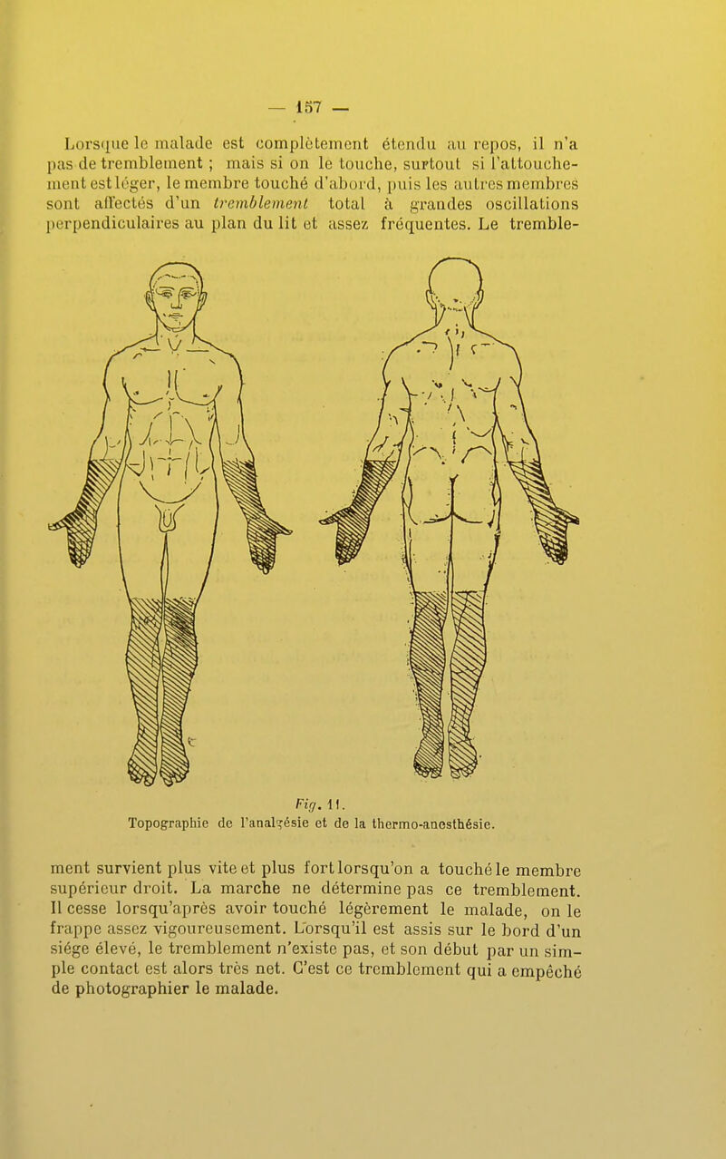 Lorsque le malade est complètement étendu au repos, il n'a pas de tremblement ; mais si on le touche, surtout si l'attouche- ment estléger, le membre touché d'abord, puis les autres membres sont affectés d'un tremblement total à grandes oscillations perpendiculaires au plan du lit et assez fréquentes. Le tremble- Fig. 11. Topographie de l'analgésie et de la thermo-anesthésie. ment survient plus vite et plus fort lorsqu'on a touché le membre supérieur droit. La marche ne détermine pas ce tremblement. Il cesse lorsqu'après avoir touché légèrement le malade, on le frappe assez vigoureusement. Lorsqu'il est assis sur le bord d'un siège élevé, le tremblement n'existe pas, et son début par un sim- ple contact est alors très net. C'est ce tremblement qui a empêché de photographier le malade.
