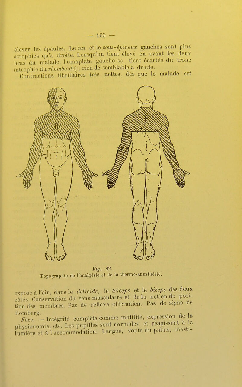 élever les épaules. Le sus et le soiis-épinoAix gauches sont plus atrophiés qu';\ droite. Lorsqu'on tient élevé en avant les deux bras du malade, l'omoplate gauche se tient écartée du tronc (atrophie du rhomboide) ; rien de semblable à droite. Contractions fibrillaires très nettes, dès que le malade est Ftg. 12. Topographie de l'analgésie et de la thermo-anesthésie. exposé à l'air, dans le delloUe, le Iricefs et le bicefs des deux côtés. Conservation du sens musculaire et delà notion de posi- tion des membres. Pas de réflexe olécranien. Pas de signe de Rombere. , . j„ i„ Face -Intégrité complète comme motilite, expression de a physionomie, etc. Les pupilles sont normales et réagissent la lurnicre et à l'accommodation. Langue, voûte du palais, masti-