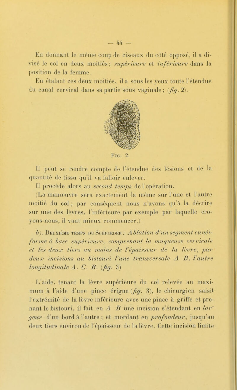 En donnant Le même coup de ciseaux du côté opposé, il a di- visé le col en deux moitiés; supérieure et inférieure dans la position de la femme. En étalant ces deux moitiés, il a sous les yeux toute l'étendue 'lu canal cervical dans sa partie sous vaginale; {fig. 2). Fig. 2. Il peut se rendre compte de l'étendue des lésions et de la quantité de tissu qu'il va falloir enlever. Il procède alors au second Ion fis de l'opération. (La manœuvre sera exactement la même sur Tune et l'autre moitié du col ; par conséquent nous n'avons qu'à la décrire sur une des lèvres, l'inférieure par exemple par laquelle cro- yons-nous, il vaut mieux commencer.) h). Deuxième temps du Schroeder : Ablution d'un segment cunéi- forme à base supérieure, comprenant Jo muqueuse cervicale et les deux tiers au moins de l'épaisseur de la lèvre, par deux incisions au bistouri /'une transversale A B, l'autre longitudinale A. C. B. [fig. 3) L'aide, tenant la lèvre supérieure du col relevée au maxi- mum à l'aide d'une pince érigne (fig. 3), le chirurgien saisit l'extrémité de la lèvre inférieure avec une pince à griffe et pre- nant le bistouri, il fait en A B une incision s'étendant en lar~ geur d'un bord à l'autre ; et mordant en profondeur, jusqu'au deux fiers environ de l'épaisseur de la lèvre. Cette incision limite