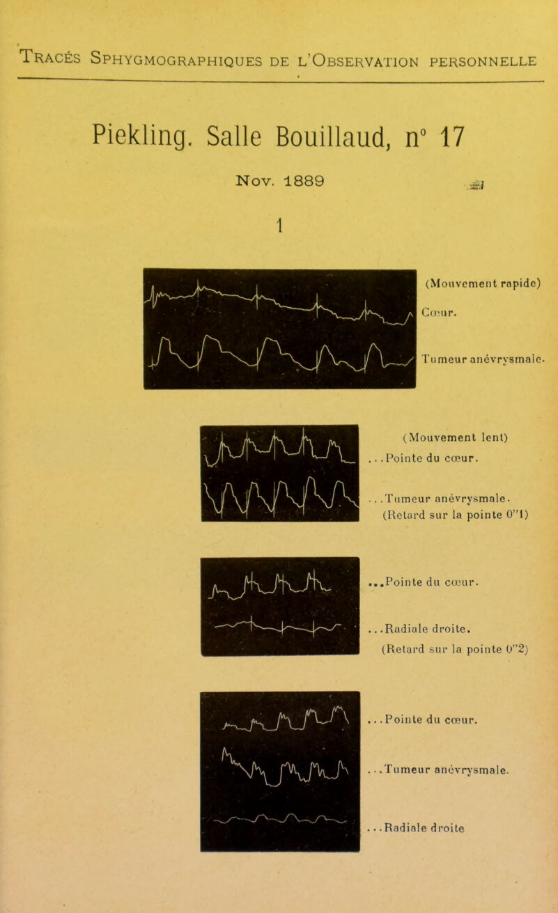 Tracés Sphygmographiques de l'Observation personnelle Piekling. Salle Bouillaud, n° 17 Nov. 1889 1 (Mouvement rapide) Cœur. Tumeur anévrysmale. (Mouvement lent) ...Pointe du cœur. .. .Tumeur anévrysmale. (Retard sur la pointe 0”i) ...Pointe du cœur. .. .Radiale droite. (Retard sur la pointe 0”2) .. .Pointe du cœur. .. .Tumeur anévrysmale. ... Radiale droite