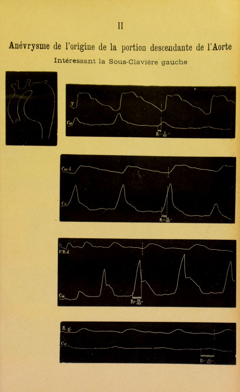 II Anévrysme de l’origine de la portion descendante de l’Aorte Intéressant la Sous-Clavière gauche