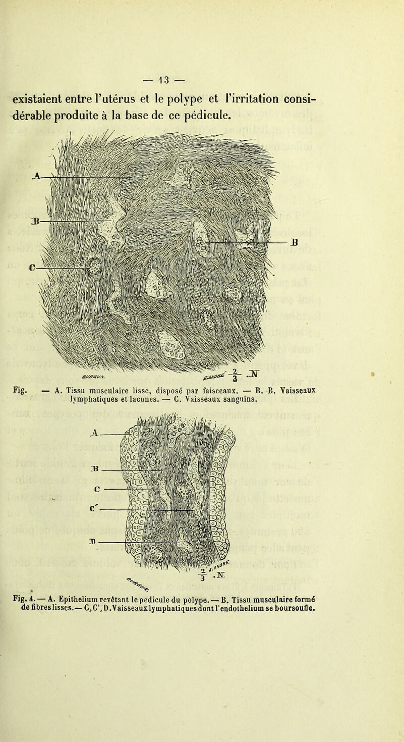 existaient entre l’utérus et le polype et l’irritation consi- dérable produite à la base de ce pédicule. Fig. — A. Tissu musculaire lisse, disposé par faisceaux. — B. B. Vaisseaux lymphatiques et lacunes. — C. Vaisseaux sanguins. Fig. i- — A. Epithelium revêtant le pédicule du polype. — B. Tissu musculaire formé de fibres lisses.— C.C’, D. Vaisseaux lymphatiques dont l’endolhelium se boursoufle.