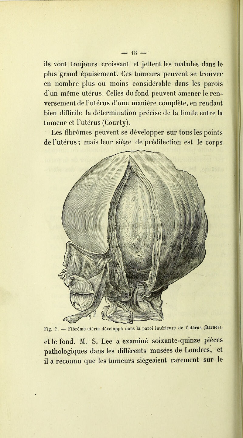 ils vont toujours croissant et jettent les malades dans le plus grand épuisement. Ces tumeurs peuvent se trouver en nombre plus ou moins considérable dans les parois d’un même utérus. Celles du fond peuvent amener le ren- versement de l’utérus d’une manière complète, en rendant bien difficile la détermination précise de la limite entre la tumeur et l’utérus (Courty). Les fibromes peuvent se développer sur tous les points de l’utérus ; mais leur siège de prédilection est le corps Fig. 7. — Fibrome utérin développé dans la paroi intérieure de l’utérus (Barnes). et le fond. M. S. Lee a examiné soixante-quinze pièces pathologiques dans les différents musées de Londres, et il a reconnu que les tumeurs siégeaient rarement sur le