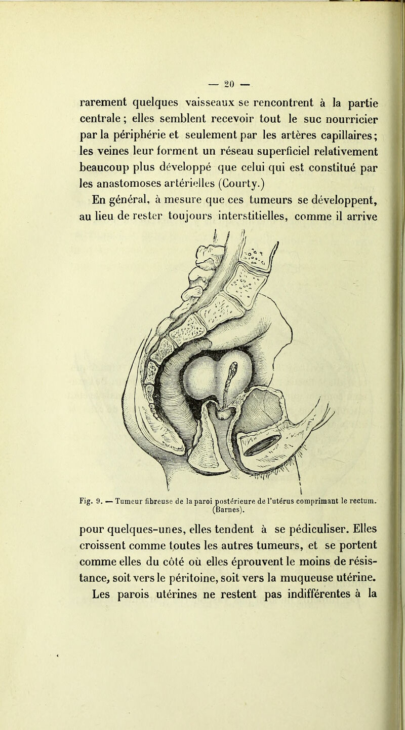 rarement quelques vaisseaux se rencontrent à la partie centrale ; elles semblent recevoir tout le suc nourricier parla périphérie et seulement par les artères capillaires; les veines leur forment un réseau superficiel relativement beaucoup plus développé que celui qui est constitué par les anastomoses artérielles (Courty.) En général, à mesure que ces tumeurs se développent, au lieu de rester toujours interstitielles, comme il arrive Fig. 9. — Tumeur fibreuse de !a paroi postérieure de l’utérus comprimant le rectum. (Barnes). pour quelques-unes, elles tendent à se pédiculiser. Elles croissent comme toutes les autres tumeurs, et se portent comme elles du côté où elles éprouvent le moins de résis- tance, soit vers le péritoine, soit vers la muqueuse utérine. Les parois utérines ne restent pas indifférentes à la