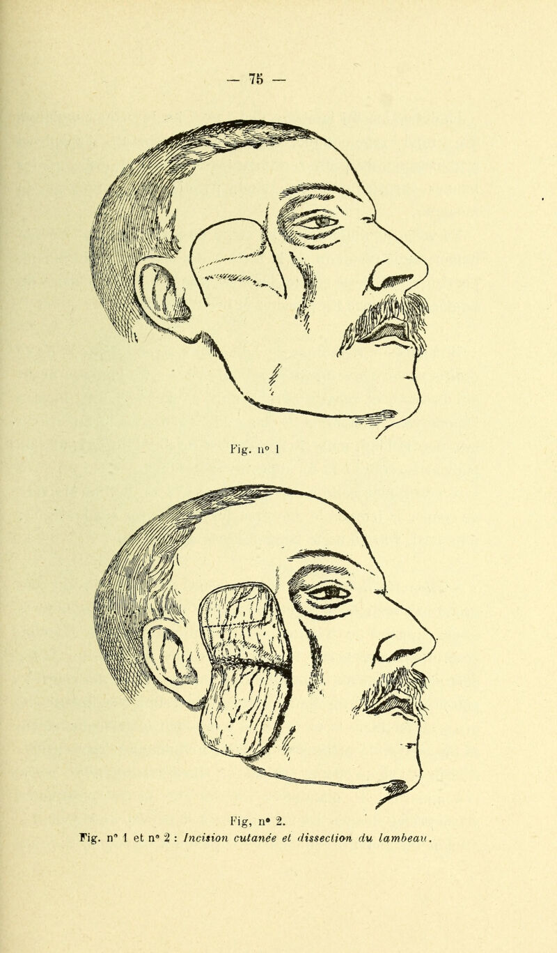 Fi g, n« 2. Fig. n 1 et n 2 : Incision cutanée et dissection du lambeau.