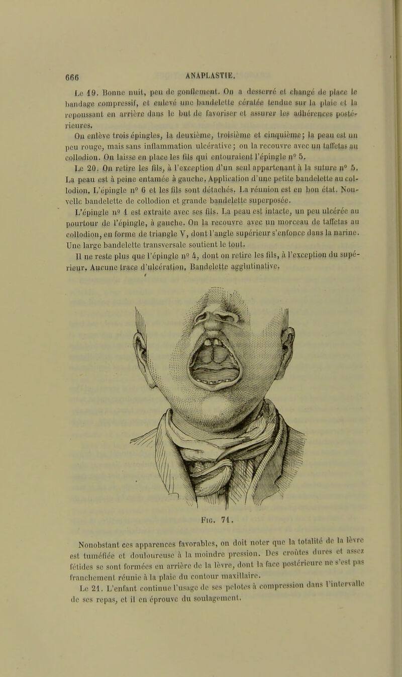 Le 10. Bonne nuit, peu de gonflement. On a desserré et changé de place le Imndage compressif, et enlevé une bandelette céralce tendue sur la plaie et la repoussant en arrière dans le but de favoriser et assurer les adhérences posté- rieures. On enlève trois épingles, la deuxième, troisième et cinquième; la peau est un peu rouge, mais sans inflammation ulcérative; on la recouvre avec un taffetas au eollmlion. On laisse en place les (ils qui entouraient l'épingle n° 5. Le 20. On retire Les fils, à l'exception d'un seul appartenant h la suture n° 5. La peau est à peine entamée à gauche, Application d'une petite bandelette au col- lodion. L'épingle n° 6 et les fils sont détachés. La réunion est en bon état. Nou- velle bandelette de collodion et grande bandelette superposée. L'épingle n' 1 est extraite avec ses fils. La peau est intacte, un peu ulcérée au pourtour de l'épingle, à gauche. On la recouvre avec un morceau de taffetas au collodion, en forme de triangle V, dont l'angle supérieur s'enfonce dans la narine. Une large bandelette transversale soutient le tout. Il ne reste plus que l'épingle n° a, dont on retire les fils, à l'exception du supé- rieur. Aucune trace d'ulcération, Bandelette agglulinative. Fig. 71. Nonobstant ces apparences favorables, on doit noter que la totalité de la lèvre est tuméfiée et douloureuse à la moindre pression. Des croûtes dures et assez fétides se sont formées en arrière de la lèvre, dont la face postérieure ne s'est pas franchement réunie à la plaie du contour maxillaire. Le 21. L'enfant continue l'usage de ses pelotes à compression clans l'intervalle de ses repas, et il en éprouve du soulagement.
