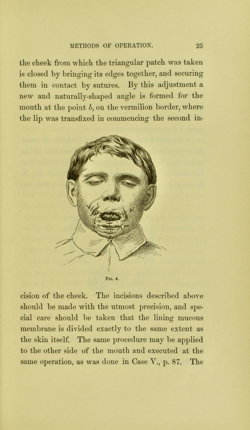 the cheek from which the triangular patch was taken is closed by bringing its edges together, and securing them in contact by sutures. By this adjustment a new and naturally-shaped angle is formed for the mouth at the point Z>, on the vermilion border, where the lip was transfixed in commencing the second in- Fig. 4. cision of the cheek. The incisions described above should be made with the utmost precision, and spe- cial care should be taken that the lining mucous membrane is divided exactly to the same extent as the skin itself. The same procedure may be applied to the other side of the mouth and executed at the same operation, as was done in Case V., p. 87. The