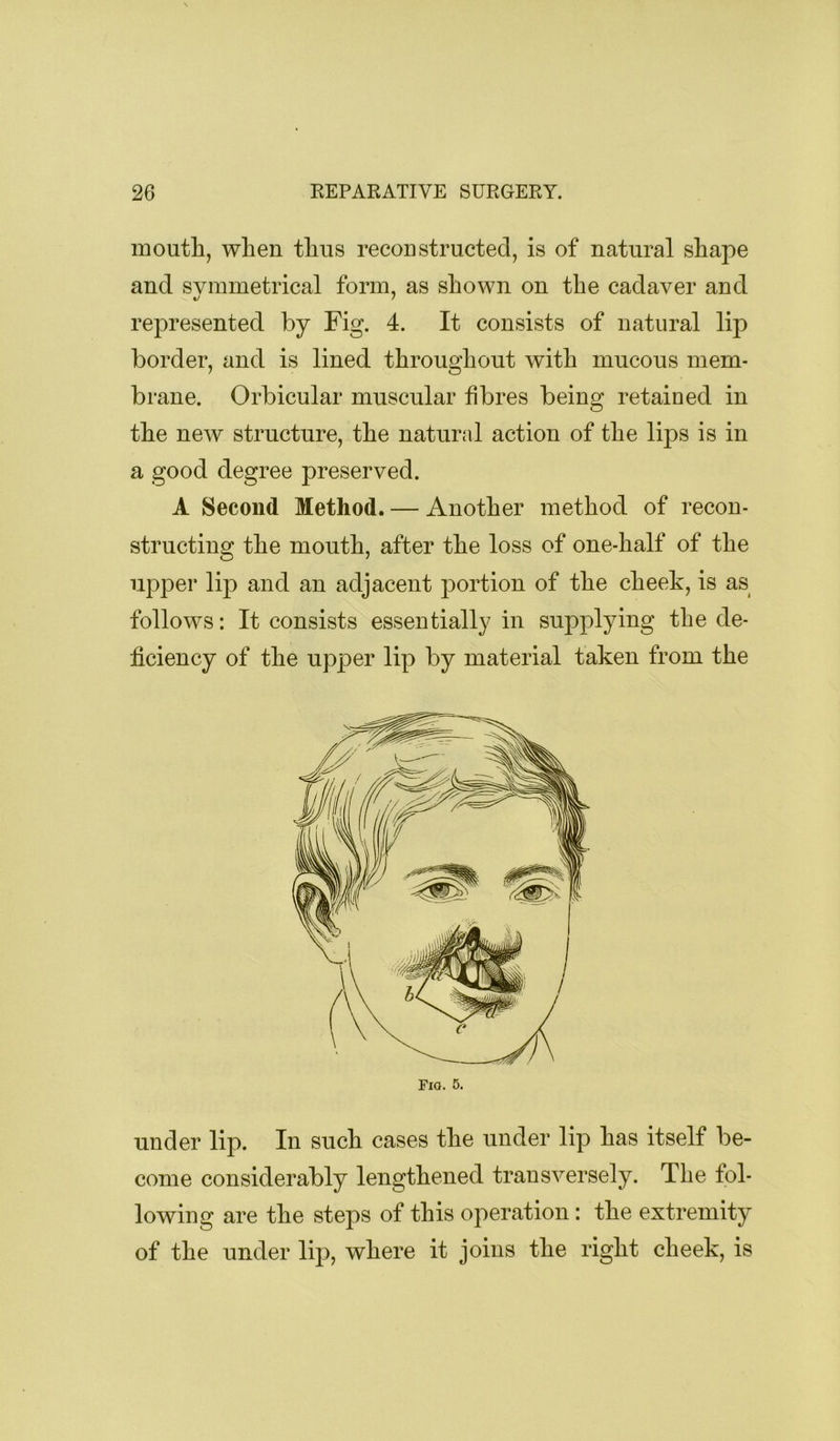 mouth, when thus reconstructed, is of natural shape and symmetrical form, as shown on the cadaver and represented by Fig. 4. It consists of natural lip border, and is lined throughout with mucous mem- brane. Orbicular muscular fibres being retained in the new structure, the natural action of the lips is in a good degree preserved. A Second Method. — Another method of recon- structing the mouth, after the loss of one-half of the upper lip and an adjacent portion of the cheek, is as follows: It consists essentially in supplying the de- ficiency of the up|)er lip by material taken from the Fio. 5. under lip. In such cases the under lip has itself be- come considerably lengthened transversely. The fol- lowing are the steps of this operation: the extremity of the under lip, where it joins the right cheek, is