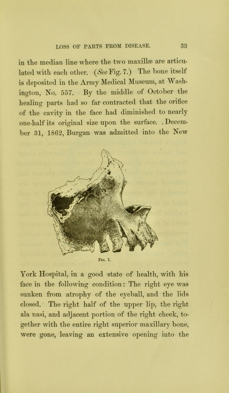 in tlie median line where the two maxillae are articu- lated with each other. (^See Fig. 7.) The bone itself is deposited in the Army Medical Museum, at Wash- ington, No. 557. By the middle of October the healing parts had so far contracted that the orihce of the cavity in the face had diminished to nearly one-half its original size upon the surface. . Decem- ber 31, 1862, Burgan was admitted into the New Fig. 7. York Hospital, in a good state of health, with his face in the following condition: The right eye was sunken from atrophy of the eyeball, and the lids closed. The right half of the upper lip, the right ala nasi, and adjacent portion of the right cheek, to- gether with the entire right superior maxillary bone, were gone, leaving an extensive opening into the