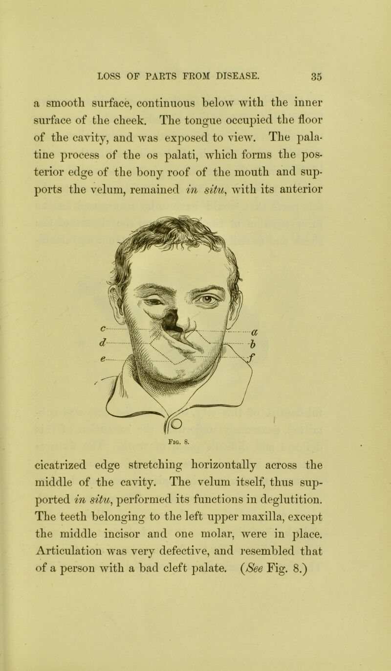 a smootli surface, continuous below with the inner surface of the cheek. The tongue occupied the floor of the cavity, and was exposed to view. The pala- tine process of the os palati, which forms the pos- terior edge of the bony roof of the mouth and sup- ports the velum, remained in situ, with its anterior cicatrized edge stretching horizontally across the middle of the cavity. The velum itself, thus sup- ported in situ^ performed its functions in deglutition. The teeth belonging to the left upper maxilla, except the middle incisor and one molar, were in place. Articulation was very defective, and resembled that of a person with a bad cleft palate. (^See Fig. 8.)