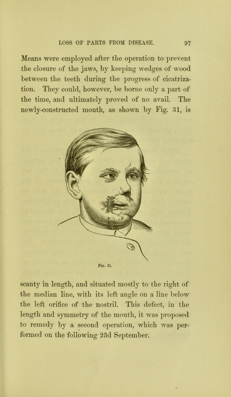 Means were employed after the operation to prevent the closure of the jaws, by keeping wedges of wood between the teeth during the progress of cicatriza- tion. They could, however, be borne only a part of the time, and ultimately proved of no avail. The newly-constructed mouth, as shown by Fig. 31, is Fig. 31. scanty in length, and situated mostly to the right of the median line, with its left angle on a line below the left orifice of the nostril. This defect, in the length and symmetry of the mouth, it was ^Droposed to remedy by a second operation, which was per- formed on the following 23d September.