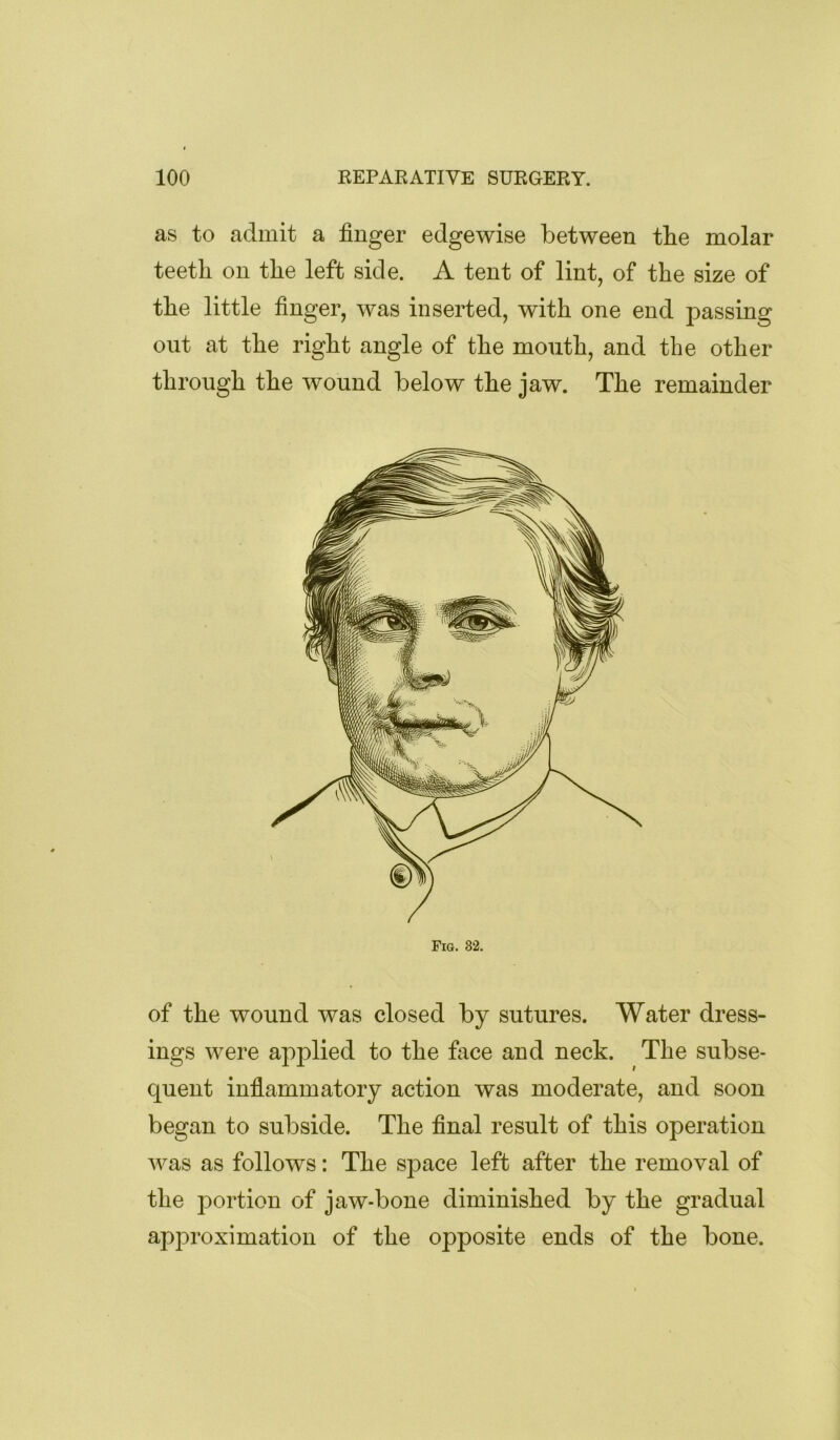 as to admit a finger edgewise between the molar teetli on the left side. A tent of lint, of the size of the little finger, was inserted, with one end passing out at the right angle of the mouth, and the other through the wound below the jaw. The remainder Fig. 82. of the wound was closed by sutures. Water dress- ings were applied to the face and neck. The subse- quent inflammatory action was moderate, and soon began to subside. The final result of this operation was as follows: The space left after the removal of the portion of jaw-bone diminished by the gradual approximation of the opposite ends of the bone.