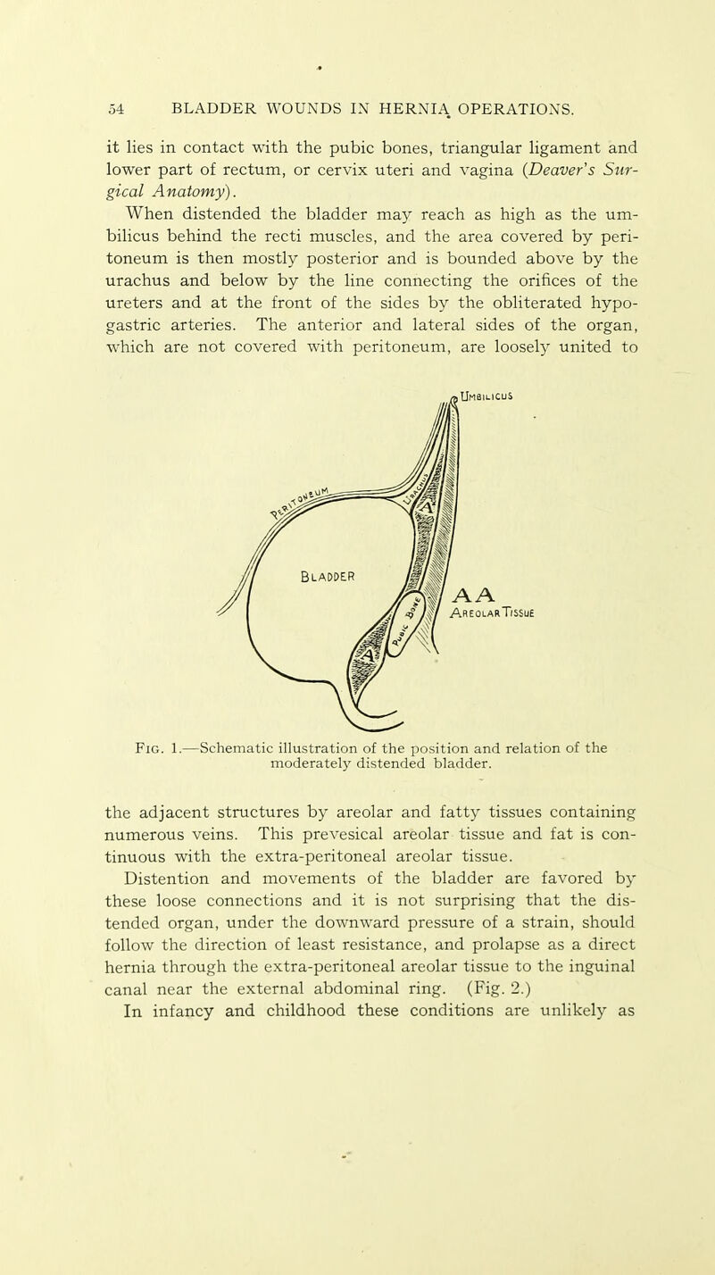 it lies in contact with the pubic bones, triangular ligament and lower part of rectum, or cervix uteri and vagina (Deavers Sur- gical Anatomy). When distended the bladder may reach as high as the um- bilicus behind the recti muscles, and the area covered by peri- toneum is then mostly posterior and is bounded above by the urachus and below by the line connecting the orifices of the ureters and at the front of the sides by the obliterated hypo- gastric arteries. The anterior and lateral sides of the organ, which are not covered with peritoneum, are loosely united to Fig. 1.—Schematic illustration of the position and relation of the moderately distended bladder. the adjacent structures by areolar and fatty tissues containing numerous veins. This prevesical areolar tissue and fat is con- tinuous with the extra-peritoneal areolar tissue. Distention and movements of the bladder are favored by these loose connections and it is not surprising that the dis- tended organ, under the downward pressure of a strain, should follow the direction of least resistance, and prolapse as a direct hernia through the extra-peritoneal areolar tissue to the inguinal canal near the external abdominal ring. (Fig. 2.) In infancy and childhood these conditions are unlikely as