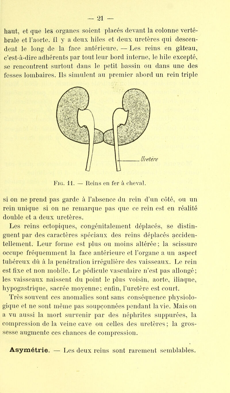 haut, et que les organes soient placés devant la colonne verté- brale et l’aorte. Il y a deux hiles et deux uretères qui descen- dent le long de la face antérieure. — Les reins en gâteau, c’est-à-dire adhérents par tout leur bord interne, le hile excepté, se rencontrent surtout dans le petit bassin ou dans une des fosses lombaires. Ils simulent au premier abord un rein triple si on ne prend pas garde à l’absence du rein d’un côté, ou un rein unique si on ne remarque pas que ce rein est en réalité double et a deux uretères. Les reins ectopiques, congénitalement déplacés, se distin- guent par des caractères spéciaux des reins déplacés acciden- tellement. Leur forme est plus ou moins altérée; la scissure occupe fréquemment la face antérieure et l’organe a un aspect tubéreux dû à la pénétration irrégulière des vaisseaux. Le rein est fixe et non mobile. Le pédicule vasculaire n’est pas allongé; les vaisseaux naissent du point le plus voisin, aorte, iliaque, hypogastrique, sacrée moyenne ; enfin, l’uretère est court. Très souvent ces anomalies sont sans conséquence physiolo- gique et ne sont même pas soupçonnées pendant la vie. Maison a vu aussi la mort survenir par des néphrites suppurées, la compression de la veine cave ou celles des uretères ; la gros- sesse augmente ces chances de compression. Asymétrie. — Les deux reins sont rarement semblables.