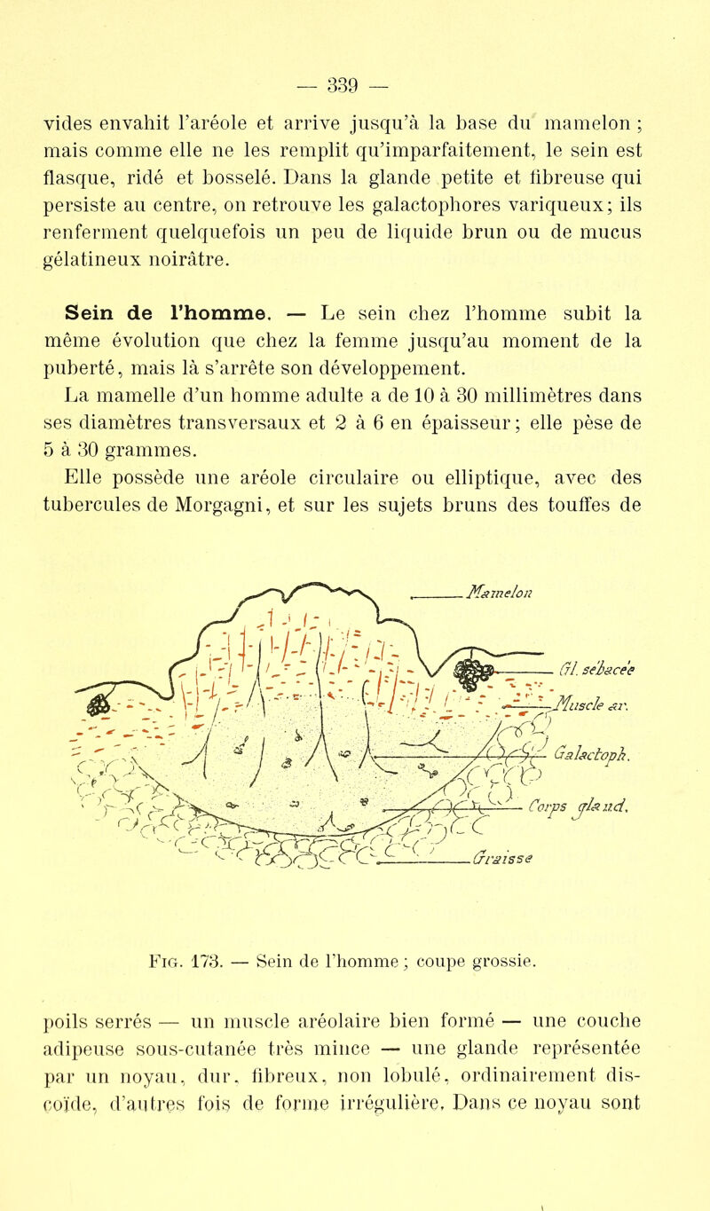 vides envahit l’aréole et arrive jusqu’à la base du mamelon ; mais comme elle ne les remplit qu’imparfaitement, le sein est flasque, ridé et bosselé. Dans la glande petite et fibreuse qui persiste au centre, on retrouve les galactophores variqueux; ils renferment quelquefois un peu de liquide brun ou de mucus gélatineux noirâtre. Sein de l’homme, — Le sein chez l’homme subit la même évolution que chez la femme jusqu’au moment de la puberté, mais là s’arrête son développement. La mamelle d’un homme adulte a de 10 à 30 millimètres dans ses diamètres transversaux et 2 à 6 en épaisseur ; elle pèse de 5 à 30 grammes. Elle possède une aréole circulaire ou elliptique, avec des tubercules de Morgagni, et sur les sujets bruns des touffes de Mamelon (H. sebace'e ai\ (jalactoph. Corps jïéiiid. Fig. 173. — Sein de l’homme ; coupe grossie. poils serrés — un muscle aréolaire bien formé — une couche adipeuse sous-cutanée très mince — une glande représentée par un noyau, dur, fibreux, non lobulé, ordinairement dis- coïde, d’antres fois de forme irrégulière. Dans ce noyau sont