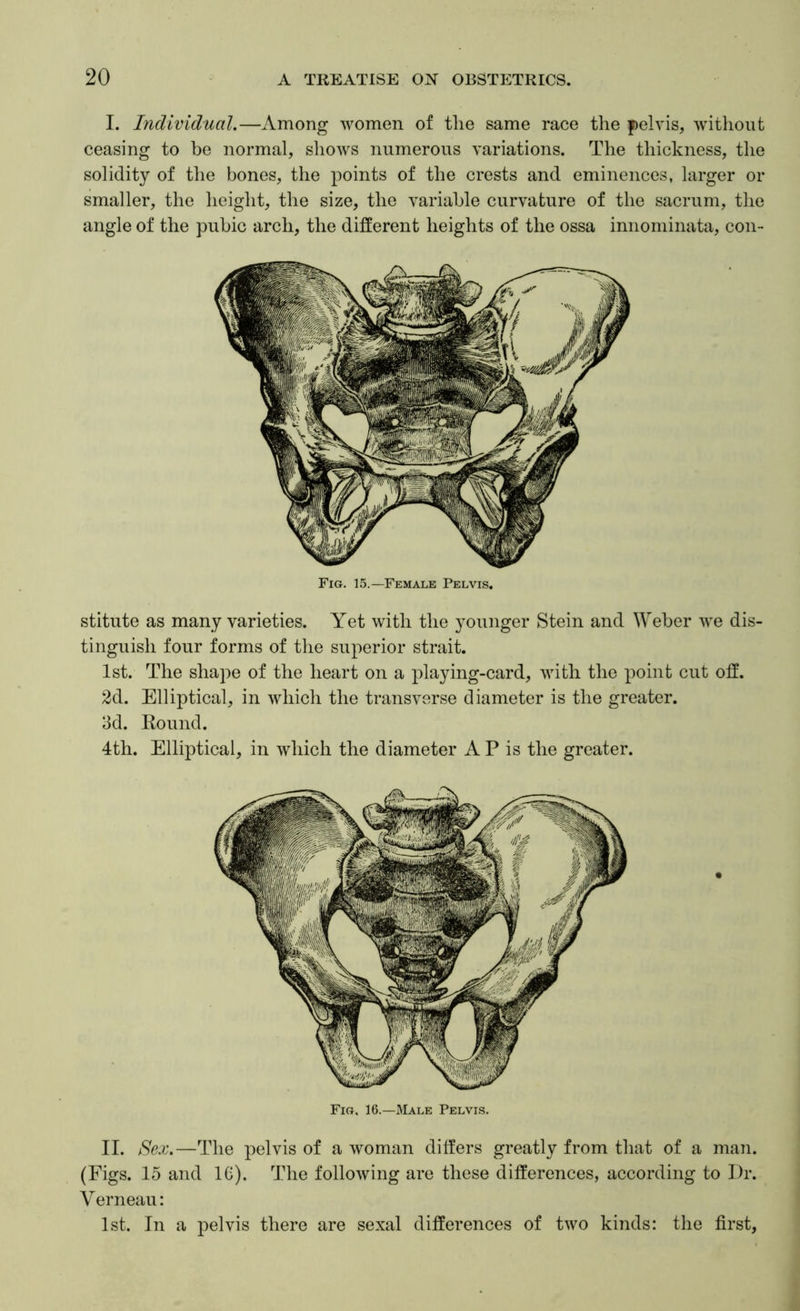 I. Individual.—Among women of tlie same race the pelvis, without ceasing to be normal, shows numerous variations. The thickness, the solidity of the bones, the points of the crests and eminences, larger or smaller, the height, the size, the variable curvature of the sacrum, the angle of the pubic arch, the different heights of the ossa innominata, con- Fig. 15.—Female Pelvis. stitute as many varieties. Yet with the younger Stein and Weber we dis- tinguish four forms of the superior strait. 1st. The shape of the heart on a playing-card, with the point cut off. 2d. Elliptical, in which the transverse diameter is the greater. 3d. Round. 4th. Elliptical, in which the diameter A P is the greater. Fig. 16.—Male Pelvis. II. Sex.—The pelvis of a woman differs greatly from that of a man. (Figs. 15 and 1C). The following are these differences, according to Dr. Verneau: 1st. In a pelvis there are sexal differences of two kinds: the first.