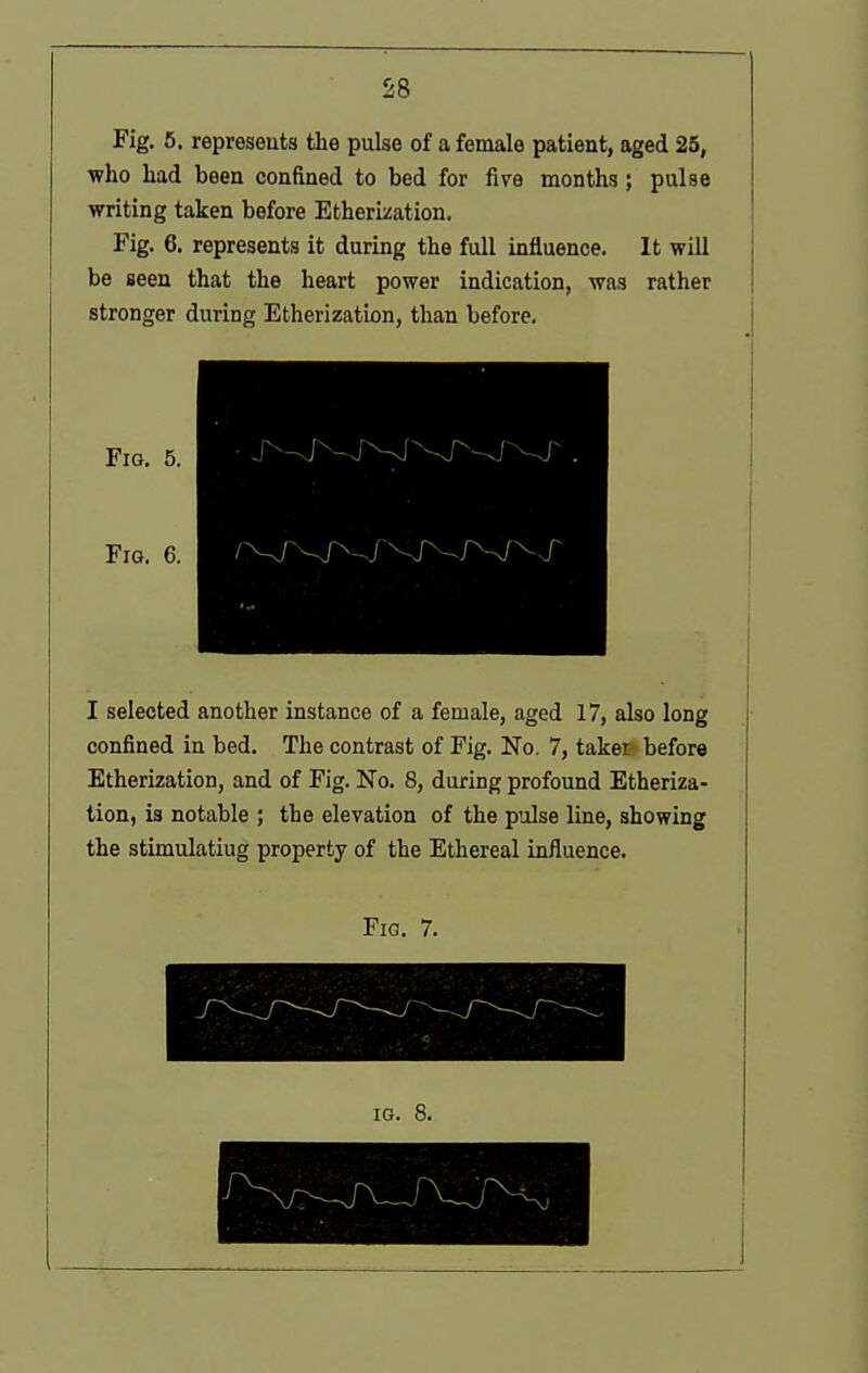 Fig. 6. represents the pulse of a female patient, aged 25, who had been confined to bed for five months; pulse writing taken before EtherLisation. Fig. 6. represents it during the full influence. It will be seen that the heart power indication, was rather stronger during Etherizatbn, than before. Fig. 5. Fig. 6. I selected another instance of a female, aged 17, also long confined in bed. The contrast of Fig. No. 7, taker' before Etherization, and of Fig. No. 8, during profound Etheriza- tion, is notable ; the elevation of the pulse line, showing the stimulatiug property of the Ethereal influence. Fia. 7. IG. 8.