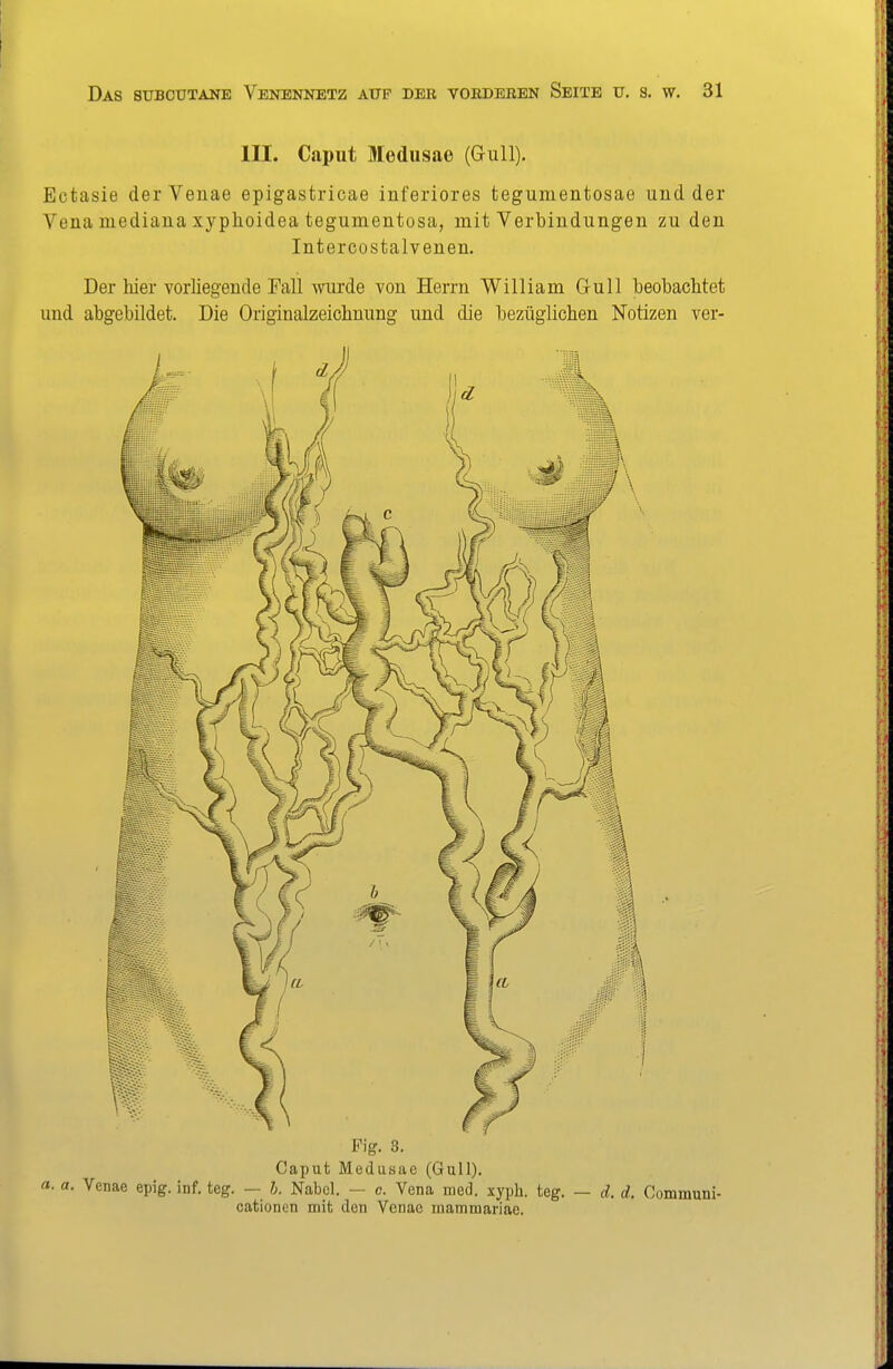 III. Caput Medusae (Gull). Ectasie der Venae epigastricae inferiores tegumentosae und der Vena mediana xyphoidea tegumentosa, mit Verbindungen zu den Intercostalvenen. Der hier vorliegende Fall wurde von Herrn William Gull beobachtet und abgebildet. Die Originalzeichnung und die bezüglichen Notizen ver- Fig. 3. Caput Medusae (Gull). a. a. Vcnae epig. inf. teg. — h. Nabel. — c. Vena med. xyph. teg. — d. d. Communi- cationen mit den Venae inammariae.