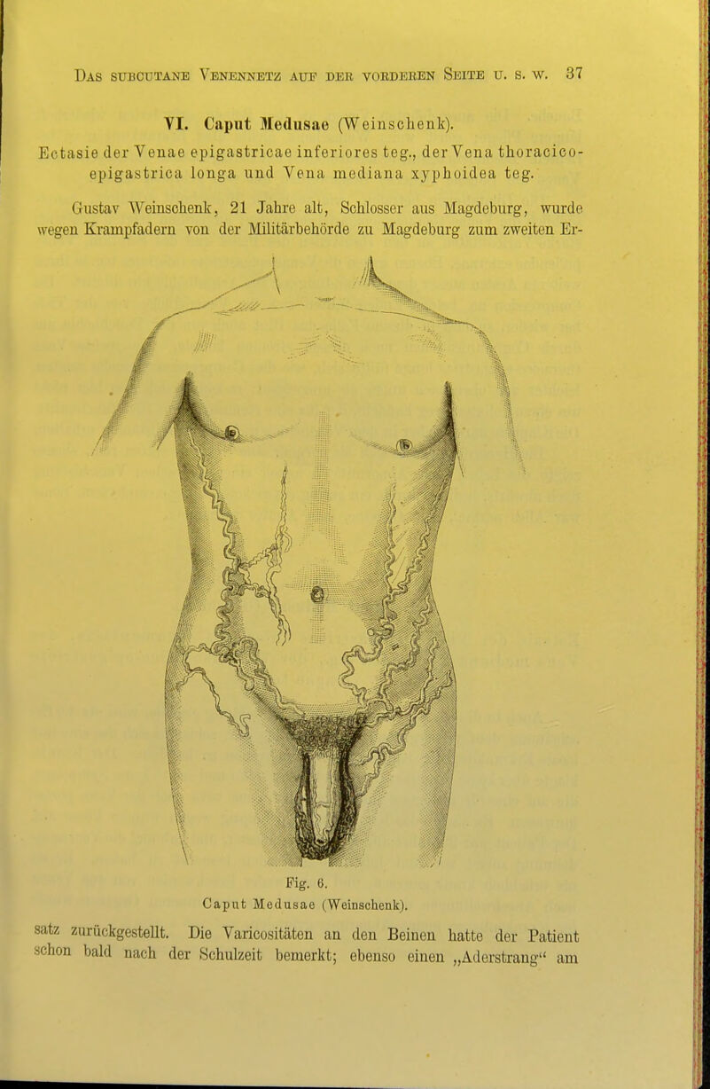 VI. Caput Medusae (Weinschenk). Ectasie der Veuae epigastricae inferiores teg., der Vena thoracico- epigastrica longa und Vena mediana xyphoidea teg. Gustav Weinschenk, 21 Jahre alt, Schlosser aus Magdeburg, wurde wegen Krampfadern von der Militärbehörde zu Magdeburg zum zweiten Er- Fig. 6. Caput Medusae (Weinschenk). Satz zurückgestellt. Die Varicositäten an den Beinen hatte der Patient schon bald nach der Schulzeit bemerkt; ebenso einen „Aderstrang am