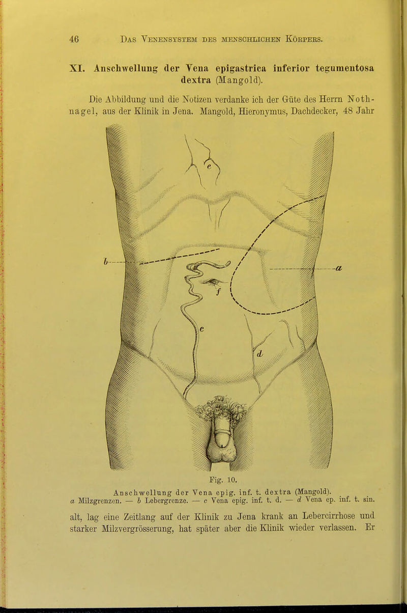 XI. Anschwellung der Vena epigastrlca inferior tegumentosa dextra (Mangold). Die Abbildung und die Notizen verdanke ich der Güte des Herrn Noth- nagel, aus der Klinik in Jena. Mangold, Hieronymus, Dachdecker, 48 Jahr Fig. 10. Anschwellung der Vena epig, inf. t. dextra (Mangold). a Milzgrenzen. — b Lebergrenze. — c Vena epig. inf. t. d. — d Vena ep. inf. t. sin. alt, lag eine Zeitlang auf der Klinik zu Jena krank an Lebercirrhose und starker Milzvergrösserung, hat später aber die Khnik wieder verlassen. Er