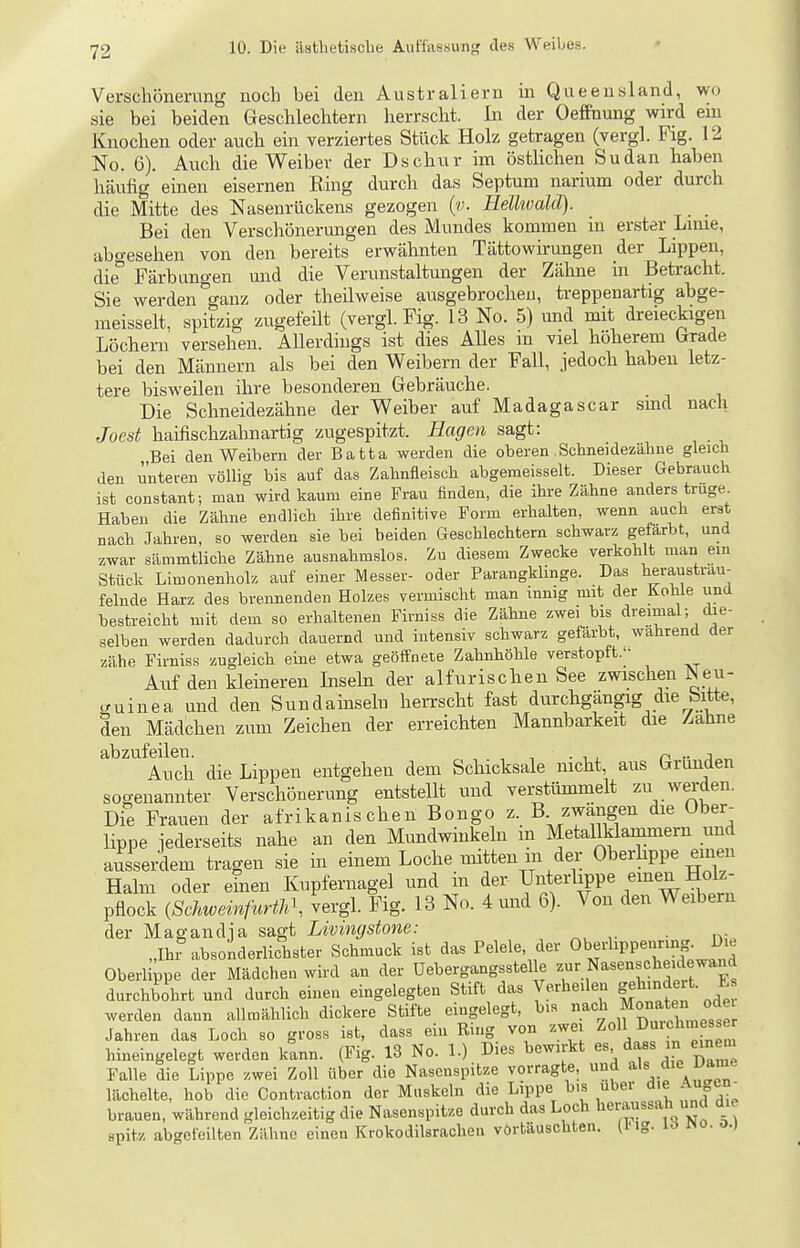 Verschönerung noch bei den Australiern in Queensland, wo sie bei beiden Geschlechtern herrscht. In der Oeffoung wird em Knochen oder auch ein verziertes Stück Holz getragen (vergl. Fig. 12 No. 6). Auch die Weiber der Dschür im östlichen Sudan haben häufig einen eisernen Ring durch das Septum narium oder durch die Mitte des Nasenrückens gezogen {v. Helhvalä). _ Bei den Verschönerungen des Mundes kommen in erster Lime, abgesehen von den bereits erwähnten Tättowirungen der Lippen, die Färbungen und die Verunstaltungen der Zähne in Betracht. Sie werden ^ganz oder theilweise ausgebrochen, treppenartig abge- meisselt, spitzig zugefeilt (vergl. Fig. 13 No. 5) und mit dreieckigen Löchern versehen. AUerdings ist dies AUes in viel höherem trrade bei den Männern als bei den Weibern der Fall, jedoch haben letz- tere bisweilen ihre besonderen Gebräuche. Die Schneidezähne der Weiber auf Madagascar sind naci\ Joest haifischzahnartig zugespitzt. Hagen sagt: Bei den Weibern der Batta werden die oberen Schneidezähne gleich den unteren völlig bis auf das Zahnfleisch abgemeisselt. Dieser Gebrauch ist constant; man wird kaum eine Frau finden, die ihre Zähne anders trüge. Haben die Zähne endlich ihre definitive Form erhalten, wenn auch erst nach Jahren, so werden sie bei beiden Geschlechtem schwarz gefärbt, und zwar sämmtliche Zähne ausnahmslos. Zu diesem Zwecke verkohlt man ein Stück Limonenholz auf einer Messer- oder Parangklinge. Das heraustrau- felnde Harz des brennenden Holzes vermischt man innig mit der Kohle und bestreicht mit dem so erhaltenen Firniss die Zähne zwei bis dreimal; die- selben werden dadurch dauernd und intensiv schwarz gefärbt, wahrend der zähe Firniss zugleich eine etwa geöffnete Zahnhöhle verstopft. Auf den kleineren Inseln der alfurischen See zwischen ^eu- ^uinea und den Sundainseln herrscht fast durchgängig die bitt«, den Mädchen zum Zeichen der erreichten Mannbarkeit die Zahne abzufeilen. entgehen dem Schicksale nicht, aus Gründen sogenannter Verschönerung entstellt und verstümmelt zu werden. Die Frauen der afrikanischen Bongo z-. B-/^ängen die Ober^ lippe iederseits nahe an den Mundwinkeln m Metallklammern mid ausserdem tragen sie in einem Loche mitten m der Oberhppe einen Halm oder eüien Kupfernagel und in der V*'^^?^'w M n pflock iSchweinfurth\ vergl. Fig. 13 No. 4 und 6). Von den Weibem der Magandja sagt Livingstone: . „Ihr absonderlichster Schmuck ist das Pelele, der O'^^^-l^PP^»^-J^'^ Oberlippe der Mädchen wird an der üebergangsstel e -'-.NaBenscheidewand durchbohrt und durch einen eingelegten Stift das Verheilen gehindeit. L werden dann allmählich dickere Stifte eingelegt, bis nach f »'^^ten ode^ Jahren das Loch so gross ist, dass ein Ring von zwei Z^^^ hineingelegt werden kann. (Fig. 13 No. 1.) Dies bewirkt es, dass in em^m Falle die Lippe zwei Zoll über die Nasenspitze vorragte, und i»-'« ^le Darne lächelte, hob die Contraction der Muskeln die Lippe bis über die Augen^ brauen, während gleichzeitig die Nasenspitze durch das Loch heraussah und die spitz abgefeilten Zähne einen Ktokodilsrachen vortäuschten. tl''g- «o- ^-^