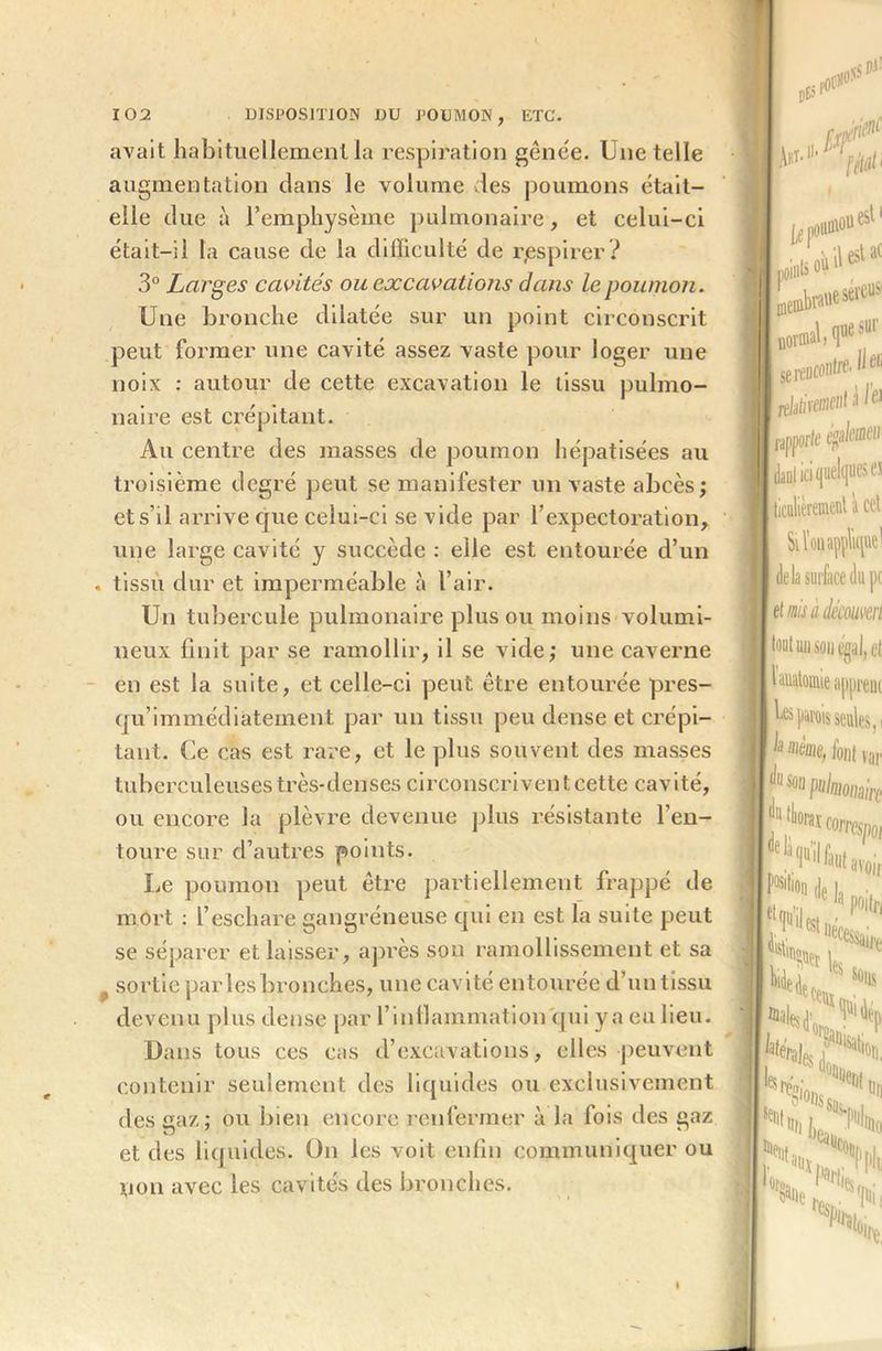 avait habituellement la respiration gênée. Une telle augmentation dans le volume des poumons était— elle due à l’emphysème pulmonaire, et celui-ci était-il la cause de la difficulté de respirer ? 3° Larges cavités ou excavations dans le poumon. Une bronche dilatée sur un point circonscrit peut former une cavité assez vaste pour loger une noix : autour de cette excavation le tissu pulmo- naire est crépitant. Au centre des masses de poumon hépatisées au troisième degré peut se manifester un vaste abcès; et s’il arrive que celui-ci se vide par l’expectoration, une large cavité y succède : elle est entourée d’un . tissu dur et imperméable à l’air. Un tubercule pulmonaire plus ou moins volumi- neux finit par se ramollir, il se vide; une caverne en est la suite, et celle-ci peut être entourée pres- qu’immédiatement par un tissu peu dense et crépi- tant. Ce cas est rare, et le plus souvent des masses tuberculeuses très-denses circonscrivent cette cavité, ou encore la plèvre devenue plus résistante l’en- toure sur d’autres points. Le poumon peut être partiellement frappé de mort : l’eschare gangréneuse qui en est la suite peut se séparer et laisser, après son ramollissement et sa , sortie parles bronches, une cavité entourée d’un tissu devenu plus dense par l’inflammation qui y a eu lieu. Dans tous ces cas d’excavations, elles peuvent contenir seulement des liquides ou exclusivement des gaz; ou bien encore renfermer à la fois des gaz et des liquides. On les voit enfin communiquer ou non avec les cavités des bronches. s P-».' Am 0 0* lOllUlûU 1 ' !i:,i Uf ***** U^esei'eus' normal, quesur serencoiiW'^11 ( fditiraaeot à le* rapporte ffllctt?11 daal ici quelques es ticiilièrement ï cet , Muf delà surface du pc \ A ois à découvert tout un son égal, et 1 anatomie appreut 1^ parois seules,! h Mme, font var JUSû° pulmonaire ,B J0BI Wrespoi '‘j'^Uvoir M* dp ï. . pan S> I
