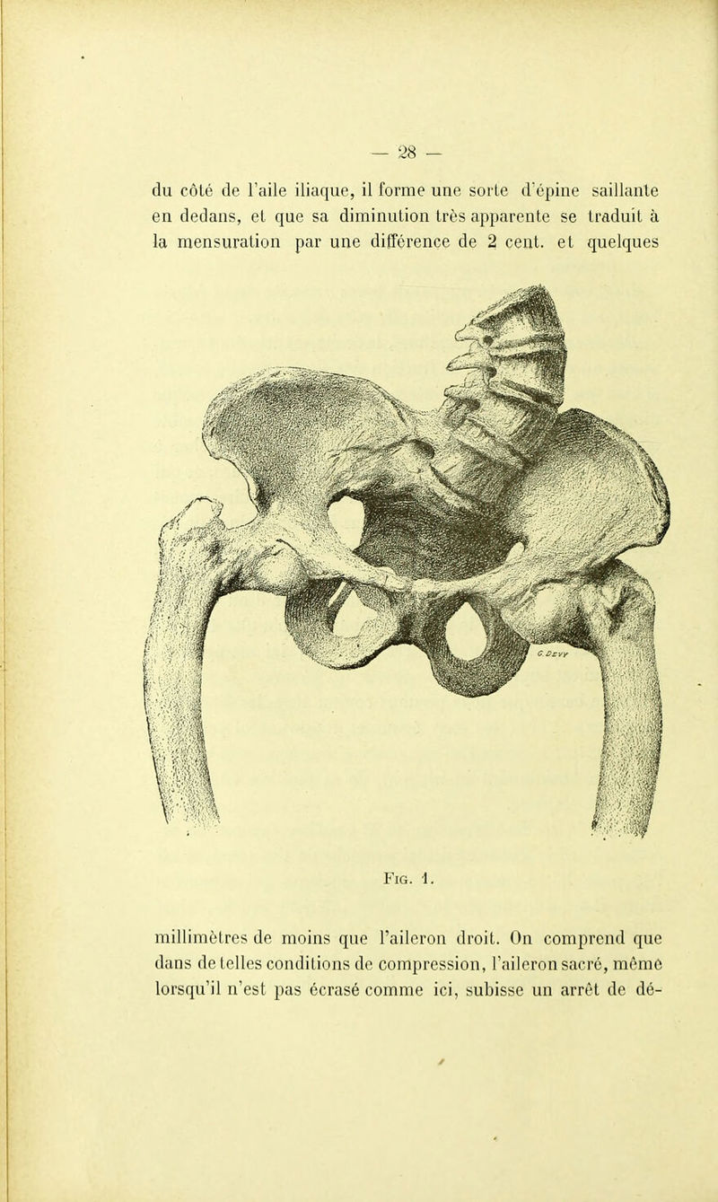du côté de l'aile iliaque, il forme une sorte d'épine saillante en dedans, et que sa diminution très apparente se traduit à la mensuration par une différence de 2 cent, et quelques FiG. i. millimètres de moins que l'aileron droit. On comprend que dans de telles conditions de compression, l'aileron sacré, mêmè lorsqu'il n'est pas écrasé comme ici, subisse un arrêt de dé-