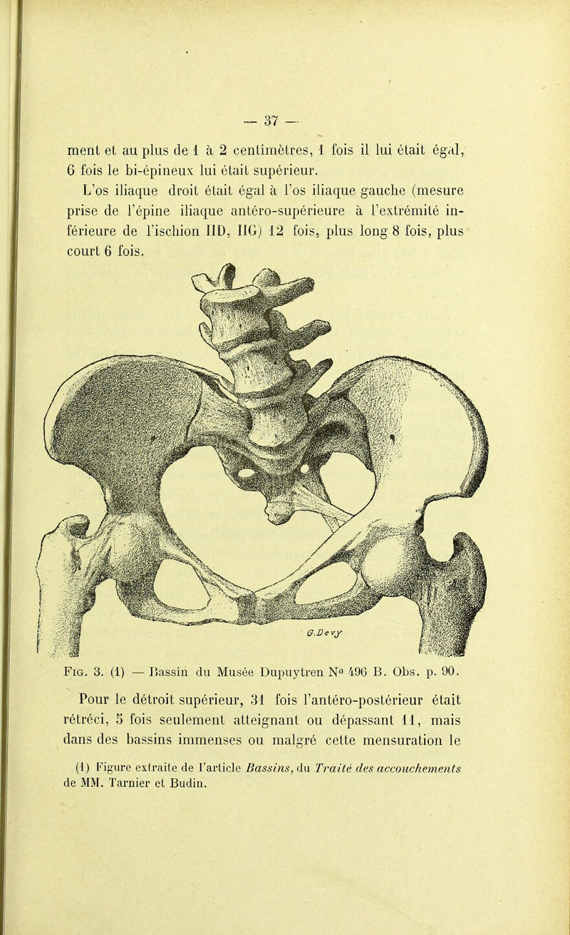 ment et au plus de 1 à 2 centimètres, 1 fois il lui était égal, 6 fois le bi-épineux lui était supérieur. L'os iliaque droit était égal à l'os iliaque gauche (mesure prise de l'épine iliaque antéro-supérieure à l'extrémité in- férieure de l'ischion IID, IIGj 12 fois, plus long 8 fois, plus court 6 fois. FiG. 3. (1) — Bassin du Musée Dupuytren N 496 B. Obs. p. 90. Pour le détroit supérieur, 31 fois l'antéro-postérieur était rétréci, S fois seulement atteignant ou dépassant 11, mais dans des bassins immenses ou malgré cette mensuration le (1) Figure extraite de l'article Bassins, du Traité des accouchements de MM. Tarnier et Budin.
