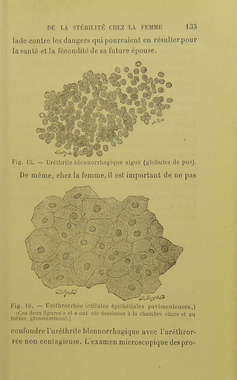 lade contre les dangers qui pourraient en résulterpour la santé et la fécondité de sa future épouse. (4 i Fig. 15. — Urélhrite blennorrhagique aiguë (globules de pus). De même, chez la femme, il est important de ne pas m Fig. 16. — Uréthrorrhée (cellules épithélialcs pavimenleuses.) (Ces deux fic-ures o et o ont ctc dessinées à la chambre claire et au môme grossissement.) confondre l'uréthrite blennorrhagique avec l'uréthror- rée non contagieuse. L'examen microscopique despro-