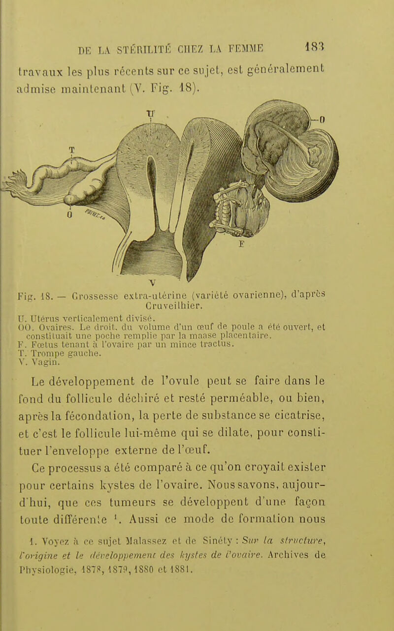 travaux les plus récents sur ce sujet, est généralement admise maintenant (V. Fig. 18). Fig. 1S. — Grossesse exlra-utérine (variélé ovarienne), d'après Cruveilhier. r. Utérus verticalement divisé. (in. Ovaires. Le droit, du volumo d'un œuf de poule a été ouvert, et constituait une poche remplie par la maase placentaire. F. Fœtus tenant à l'ovaire par un mince tractus. T. Trompe gauche. V. Vagin. Le développement de l'ovule peut se faire dans le fond du follicule déchiré et resté perméable, ou bien, après la fécondation, la perte de substance se cicatrise, et c'est le follicule lui-même qui se dilate, pour consti- tuer l'enveloppe externe de l'œuf. Ce processus a été comparé à ce qu'on croyait exister pour certains kystes de l'ovaire. Nous savons, aujour- d'hui, que ces tumeurs se développent d'une façon toute différent '. Aussi ce mode de formation nous 1. Voyez à ee sujet Malassez cl do Sinéty : Sur la structure, t'origine et le développement des kystes de ïovaire. Archives de Physiologie, 1878, 1S7P,1SS0 et 1881.