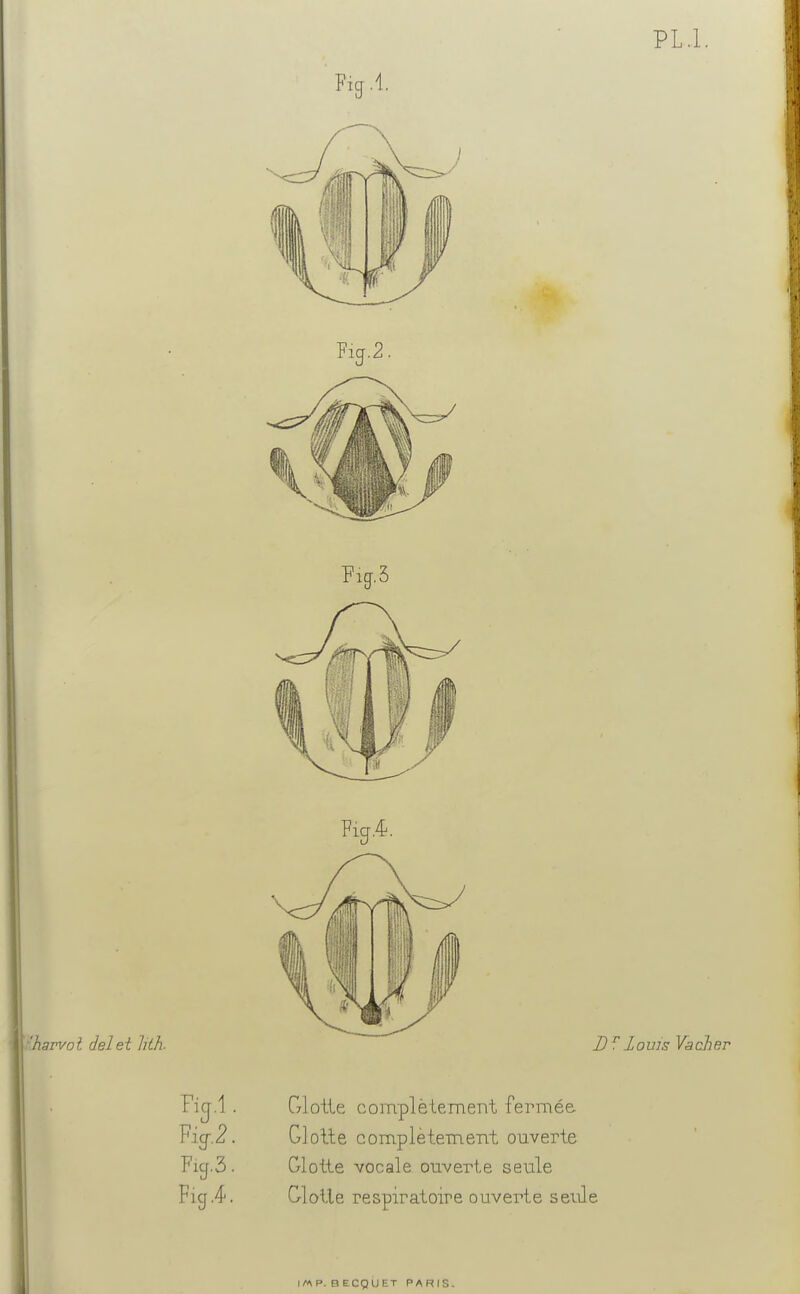 PL.l. Fig.1 Fij.2 Ficj.l . Griotte complètement fermée Fig-,2. Glotte complètement ouverte Fij.3 ■ Glotte vocale ouverte seule Fief .4-. Clotle respiratoire ouverte seule |/v\P. BECQUET PARIS.