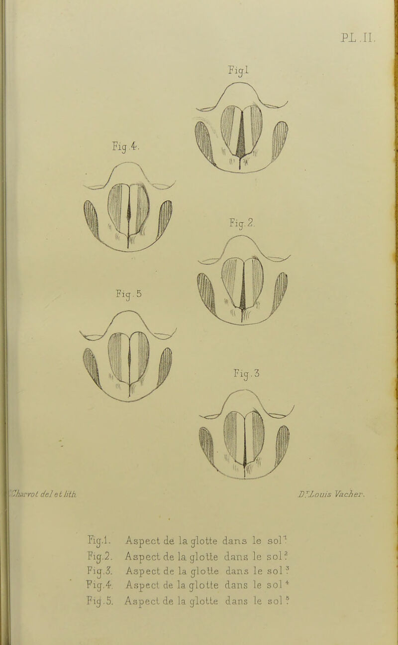 PL. II 7Jiarrol del eth'tk Fig.£. Fier. 5 Fia. 2. Fia. 3 Rg.l. Fig.2. Fia.5. Fig.4. Fia. 5. Aspect de la glotte dans le sol1 Aspect de la glotte dans le sol2 Aspect de la glotte dans le sol ? Aspect de. la glotte dans le sol * Aspect de la glotte dans le sol* DTZauis Vacher.