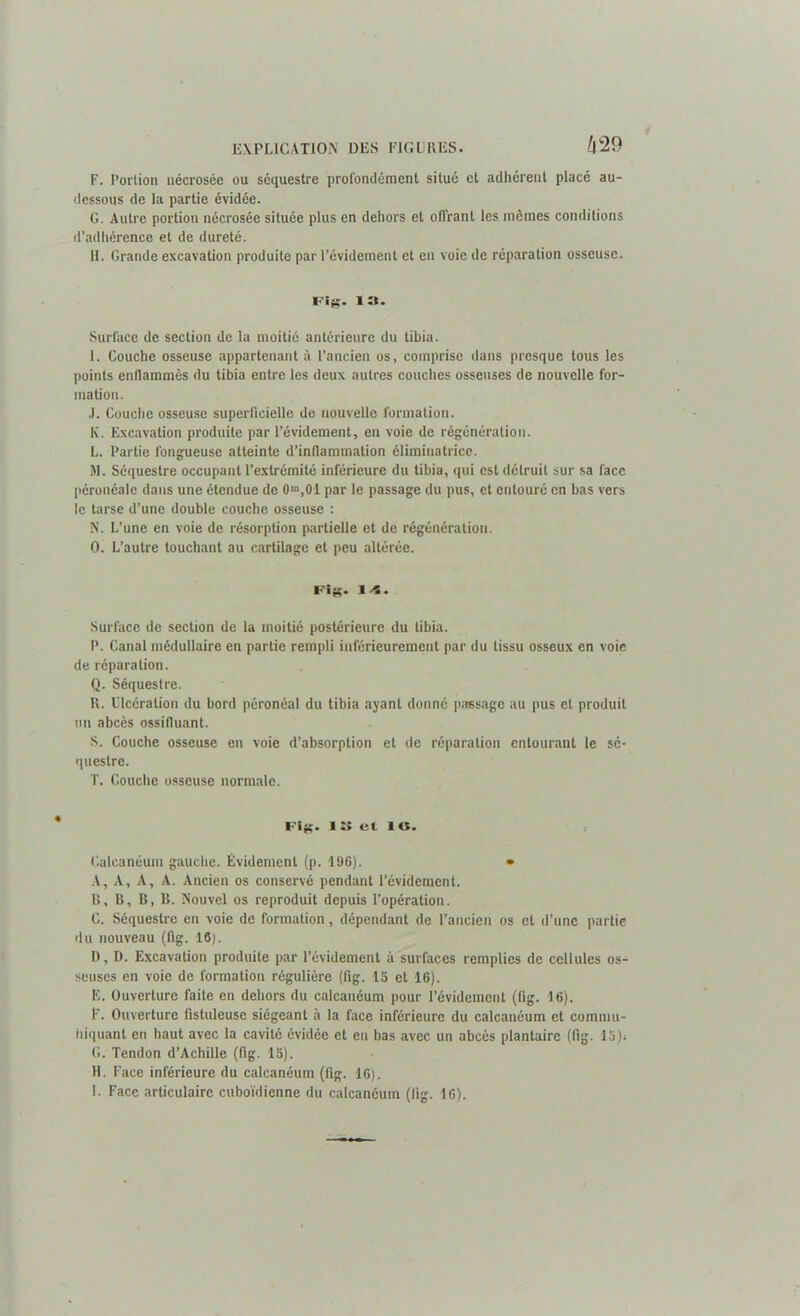 F. Portion nécrosée ou séquestre profondément situé et adhérent placé au- dessous de la partie évidée. G. Autre portion nécrosée située plus en dehors et offrant les mêmes conditions d’adhérence et de dureté. 11. Grande excavation produite par l’évidement et en voie de réparation osseuse. Fis- 13. Surface de section de la moitié antérieure du tibia. I. Couche osseuse appartenant à l’ancien os, comprise dans presque tous les points enflammés du tibia entre les deux autres couches osseuses de nouvelle for- mation. J. Couche osseuse superficielle de nouvelle formation. K. Excavation produite par l’évidement, en voie de régénération. L. Partie fongueuse atteinte d’inflammation éliminatrice. M. Séquestre occupant l’extrémité inférieure du tibia, qui est détruit sur sa face péronéale dans une étendue de 0“,01 par le passage du pus, et entouré en bas vers le tarse d’une double couche osseuse : N. L’une en voie de résorption partielle et de régénération. O. L’autre touchant au cartilage et peu altérée. Fl«. 14. Surface de section de la moitié postérieure du tibia. P. Canal médullaire en partie rempli inférieurement par du tissu osseux en voie de réparation. Q. Séquestre. R. Ulcération du bord péronéal du tibia ayant donné passage au pus et produit un abcès ossifluant. S. Couche osseuse en voie d’absorption et de réparation entourant le sé- questre. T. Couche osseuse normale. î *> cii î o* Calcanéum gauche. Évidement (p. 196). • A. A, A, A. Ancien os conservé pendant l’évidement. B. B, B, B. Nouvel os reproduit depuis l’opération. C. Séquestre en voie de formation, dépendant de l’ancien os et d’une partie du nouveau (fig. 16). D. D. Excavation produite par l’évidement à surfaces remplies de cellules os- seuses en voie de formation régulière (fig. 15 et 16). E. Ouverture faite en dehors du calcanéum pour l’évidement (fig. 16). F. Ouverture fistuleuse siégeant à la face inférieure du calcanéum et commu- hiquant en haut avec la cavité évidée et en bas avec un abcès plantaire (fig. 13); G. Tendon d’Achille (fig. 15). H. Face inférieure du calcanéum (fig. 16). L Face articulaire cuboïdienne du calcanéum (fig. 16).