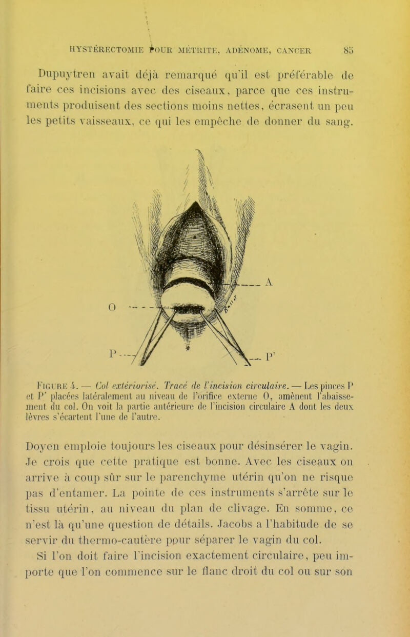 Dupiiytren avait dcjà remarqué qu'il est préférable de faire ces incisions avec des ciseaux, parce que ces instru- ments produiseut des sections moins nettes, écrasent un peu les petits vaisseaux, ce qui les empêche de donner du sang. l''lGL RE i. — (lui ('Xlériorisr. Tracé de l'incision circulaire. — Los {lincos P et P' placées latéralement au niveau de l'orifice externe 0, amènent l'abaisse- ment du col. On voit la partie antérieure de riiicision circulaire A dont les deux lèvres s'écartent Tune de l'autre. Doyen emploie toujours les ciseaux pour désinsérer le vagin. Je crois que cette pratique est bonne. Avec les ciseaux on arrive à coup sur sur le parenchyme utérin qu'on ne risque pas d'entamer. La pointe de ces instruments s'arrête stu' le tissu utérin, au niveau du plan de clivage. En somme, ce n'est là qu'une question de détails. Jacobs a l'habitude de se servir du thermo-cautère ppur séparer le vagin du col. Si l'on doit faire l'incision exactement circulaire, peu im- porte que l'on conmience sur le flanc droit du col ou sur son