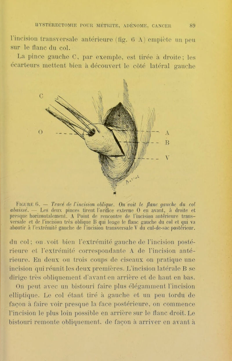 rincisioli transvorsalo antérieure (fig. 0 A) einpiMe un pou sur le riauc du col. La pince gauche C, par exemple, est tirée à droite; les écarteurs mettent bien à découvert le côté latéral gauche Kir.l RK (i. — Tracé (le l'incision oblique. On voit le flanc fjauche du col abaissé. — Les deux pinces liront lorifice cxlorno 0 en avant, à di'oile cl pres(|n(' liorizonlalemenl. A l'oint de ronconlre de riiicision aiitcrieuie trans- vocsalc et do l'incision trôs oblique B qui ionise le flanc puclio du col et (lui va alionlir à rextréniité gaudu^ do rincision transversale V du cul-do-sac postérieur. du col; on.voit bien l'extrémité gauche de Tincision posté- rieure et l'extrémité correspondante A de l'incision anté- rieure. En deux on trois coups de ciseaux on })ratique ime incision qui réunit les deux premières. L'incision latérale B se dirige très obliquemeni d'avant en arrière et de haut en bas. On peut avec un bisionri faire plus élégamment l'incision elliptique. Le col étant tiré à gauche et nu peu tordu de façon à (aire voir presque la face postérieure, on commence rincision le plus loin possible en arrière sur le flanc droit. Le bistouri remonte obliquement, de façon k arriver en avant à