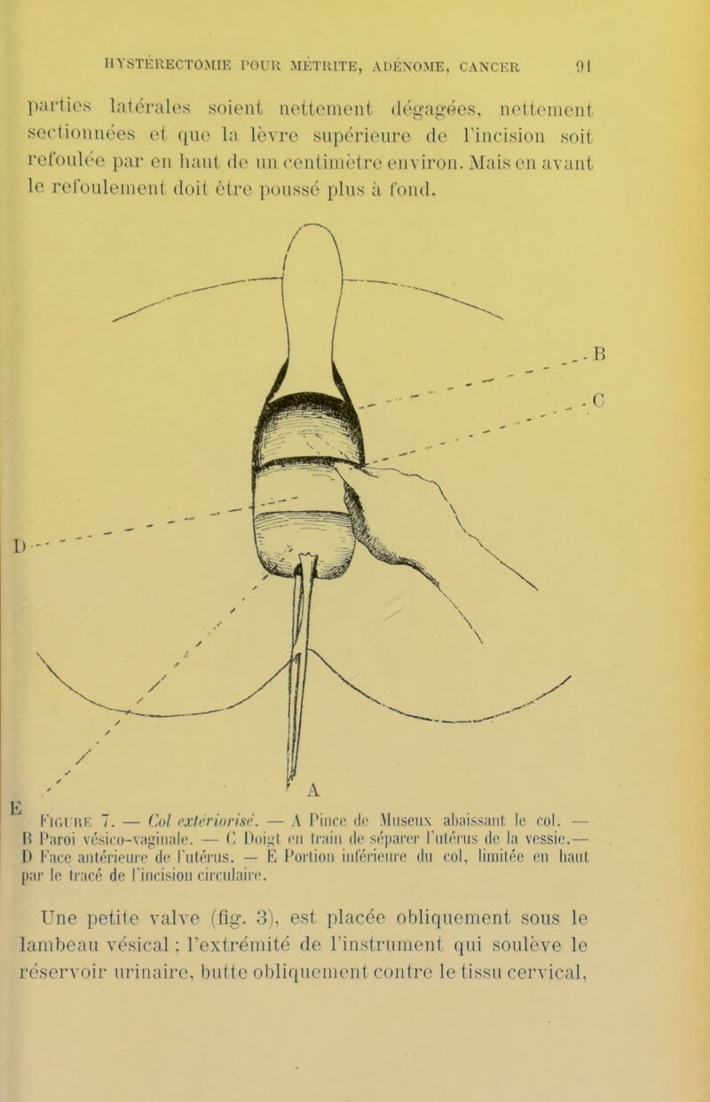 parties latérales soient nettement ilégaii'ées, nettement sectionnées et qne la lèvre snpérieiire de Tincision soit rcfonlée par en liant de nn centimètre environ. Mais en avant le refonlement doit être ponssé plus à fond. ,-B . - C FlGl RK T. — Col t'xlérioris('. — A Piiico de Miiscux abaissait, le roi. — B Paroi vôsicu-vagiiialc. — C Doii^l en train do s('|)ar(M' l'iilrriis de, la vessie.— D Face aiUérieiire de ruléi'iis. — E J'orlioii iiirérieiire du col, limitée en liant, par le tracé de rincision circidaire. Une petite valve (fig. 3), est placée obliquement sous le lambeau vésical ; l'extrémité de l'instrument qui soulève le réservoir urinaire, butte obliquement contre le tissu cervical,