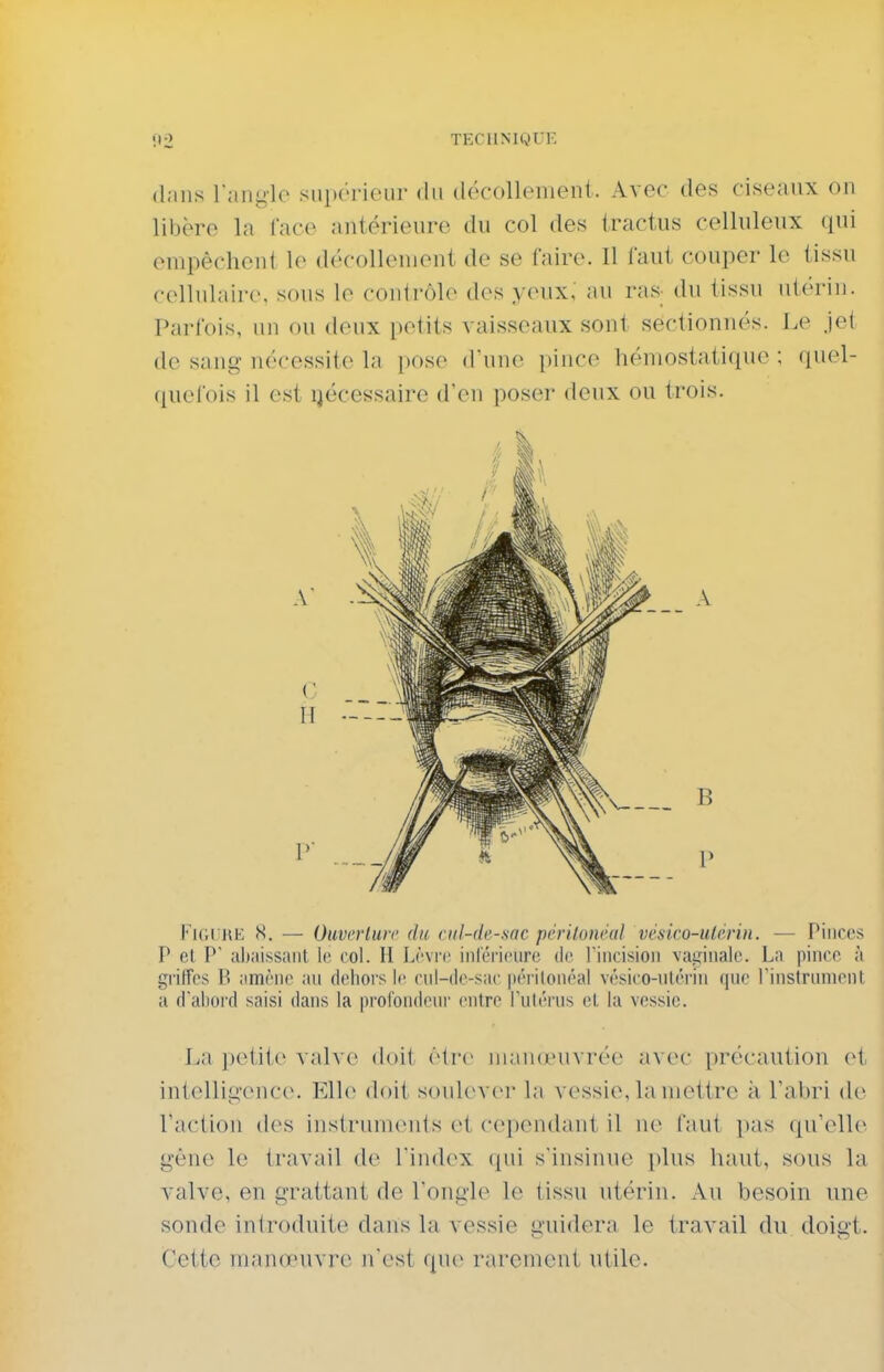 (Iniis laii-lc siip(-i'i{'iii' dit tlôcollement. Avec des ciseaux on libère la face antérieure du col des iractus celluleux qui empêchent le décollement de se Caire. Il faut couper le tissu cellulaire, sous le contrôle des yeux, au ras- du tissu utérin. Parlbis, un ou deux petits vaisseaux sont sectionnés. Le jet de sang nécessite la pose d'une pince hémostatique ; quel- quefois il est ijécessaire d'en poser deux ou trois. FitanE H. ■— Oiwcrluic du rid-de-.soc j)i'rilonv(d vésico-ulcrin. — Pinces ' P el P al)aissant le col. II Lèvre inréncure de riiicisioii vaiïinalc. La pince à griffes B iimène au doliors le rnl-do-sac |in i(onéal vésico-nlériii que rinstrument a d'abord saisi dans la profondcui' entre fulérus cl la vessie. La petite valve doit être nwMueuvrée avec précaution et | intelligence. Elle doit soulever la vessie, la mettre à l'abri de I l'action des instruments et cependant il ne faut pas qu'elle gène le travail de Tindex (pii s'insinue plus haut, sous la valve, en grattant de l'ongle le tissu utérin. Au besoin une sonde introduite dans la vessie u'uidera le travail du doigt. Cette manœuvre n'est que rarement utile. B P