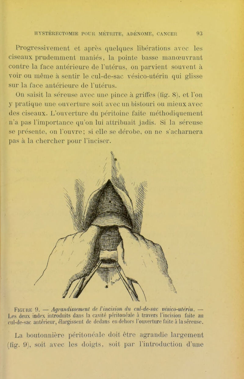 ProgTcssivenicnt et après quelques libérations avec les ciseaux prudemment maniés, la pointe basse manœuvrant contre la face antérieure de l'utérus, on parvient souvent à voir ou même à sentir le cul-de-sac vésico-utérin qui glisse sur la face antérieure de Tutérus. On saisit la séreuse avec une pince à griflos (lig-. 8), et l'on y pratique une ouverture soit avec un bistouri ou mieux avec des ciseaux. L'ouverture du péritoine faite méthodiquement n'a pas l'importance qu'on lui attribuait jadis. Si la séreuse se présente, on l'ouvre; si elle se dérobe, on ne s'acliarnera pas à la chercher pour l'inciser. Figure 9. — Agrandissemml (h rincision du cul-de-sac vésico-ulèrin. — Les deux indi'x introduits dans la cavité péritoiiéalc à travers rincision laite au cnl-de-sac antérieur, élargissent de dedans en dehors l'ouverture faite à la séreuse. La boutonnière péritonc'ale doit être agrandie largement