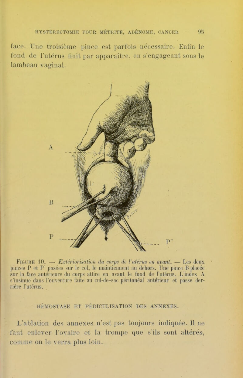 laco. Vue Iroisiî.'ino pince est parfois iiccossairo. Enliii lo fond (le rutëriis (inii par apparaître, eu s'engagcant sous le lambeau vaginal. P' Fir.rriE 10. — Exfériorisation du corps de Vutérus en avant. — Les deux j)iiic('S [' cl P posées sur le eol, le mainlieiinent .'iii dehors. Une pince H placée sin' la face antéi ieure du corjis atlii'c en avant, le fond de rulénis. L'index A siiisimie dans l'ouverture laite au cul-de-sac péritonéal antérieur et passe der- rière l'utérus. HÉMOSTASE ET PÉDICULISATION DES ANNEXES. L'ablation des annexes n'est pas toujours indiquée. 11 no faut enlever l'ovaire et la trompe que s'ils sont altérés, comme on le verra plus loin.