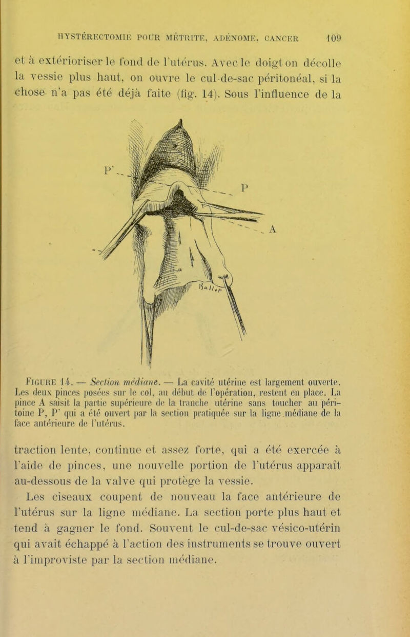 et à extérioriser le fond do l'iitonis. Avec le tloigi on (h'coUc la vessie plus haut, on ouvre le cul de-sac péritonéal, si la chose n'a pas été déjà faite (fig. 14). Sous l'influence de la Figure \ i. — Seclion mpdiaue. — La cavité utérine est largement ouverte. Les deux pinces posées sur le col. au début de ropéralion, restent eu place. La pince A saisit la [lartie supérieure de la tranche iitéi-ine sans toucher au péri- toine P, P (pii a été oiiverl par la seclion prati(piée sur la ligne médiane de la face antérieure de l'utérus. traction lente, continue et assez forte, qui a été exercée à l'aide de pinces, une nouvelle portion de l'utérus apparaît au-dessous de la valve qui protège la vessie. Les ciseaux coupent de nouveau la face antérieure de l'utérus sur la ligne médiane. La section porte plus haut et tend à gagner le fond. Souvent le cul-de-sac vésico-utérin qui avait échappé à l'action des instruments se trouve ouvert à rimproviste par la section médiane.