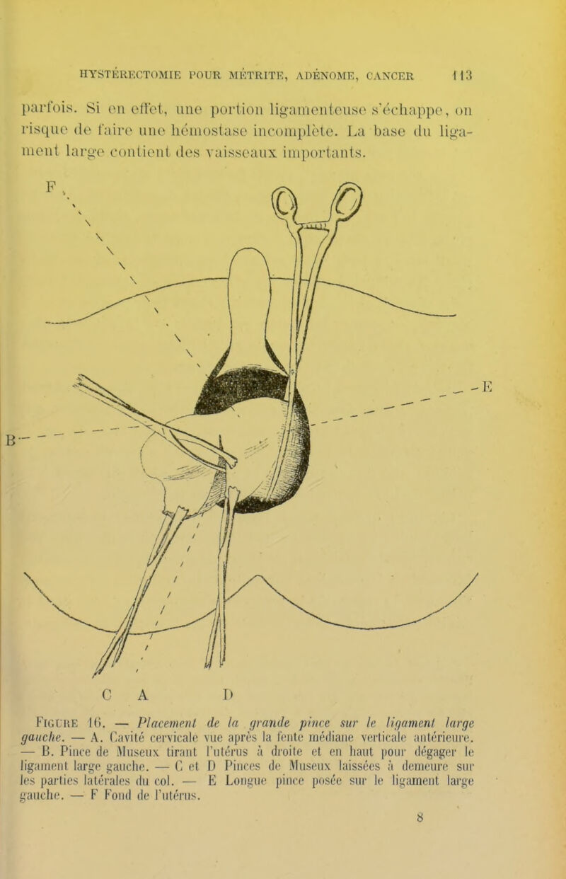 parfois. Si (mi ellet, une portion ligamentouso s'échappe, on risque dv l'aire une hémostase incomplète. La base du lig'a- ment laro-e contient des vaisseaux importants. C A D Figure 1(1. — Placement de In grande pince sur le ligament large gauche. — A. Cavité cervicale vue après la Iciitc médiane verticale aiilérieiire. — B. Pince de Museux tirant l'utérus à droite et eu haut pour dégager le ligament large gauche. — C et D Pinces do Museux laissées à demeure sur les parties latérales du col. — E Longue pince posée sur le ligament large gauche. — F Fond de l'utérus.